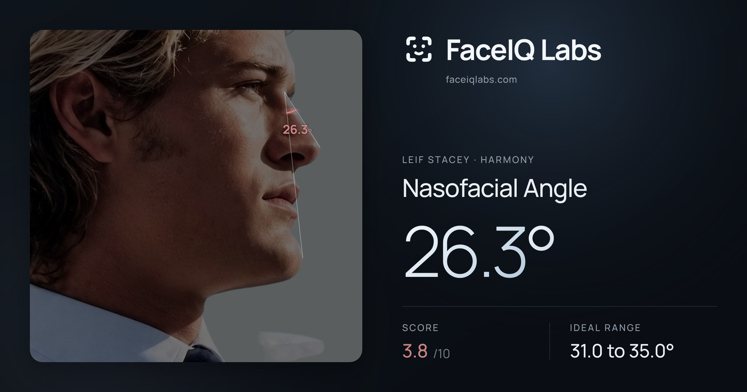 Leif Stacey Nasofacial Angle: 26.3°, drawn on the photo
