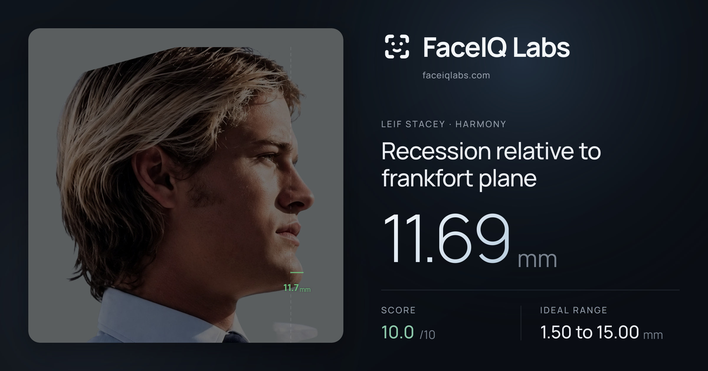 Leif Stacey Recession relative to frankfort plane: 11.69mm, drawn on the photo
