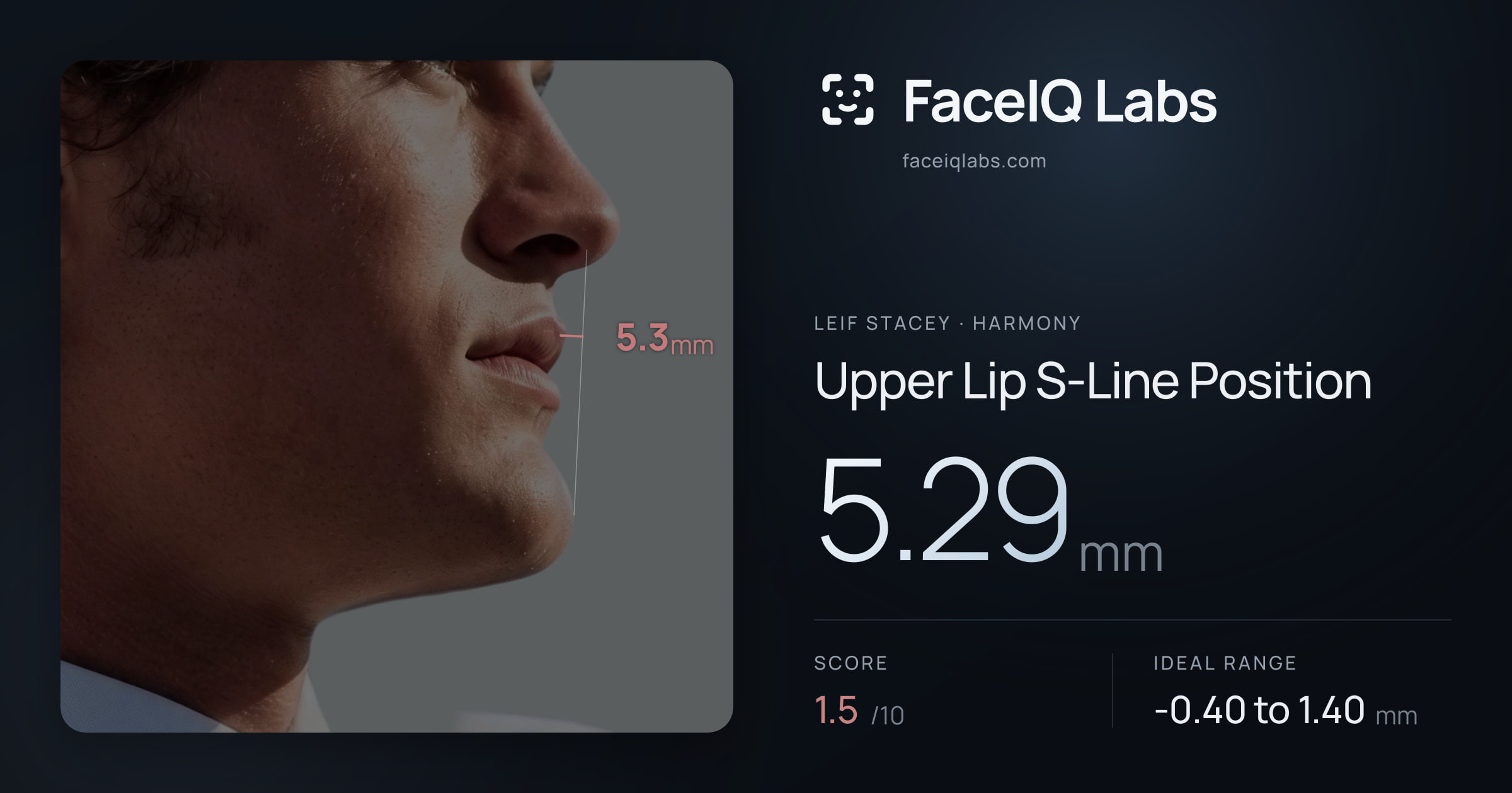 Leif Stacey Upper Lip S-Line Position: 5.29mm, drawn on the photo