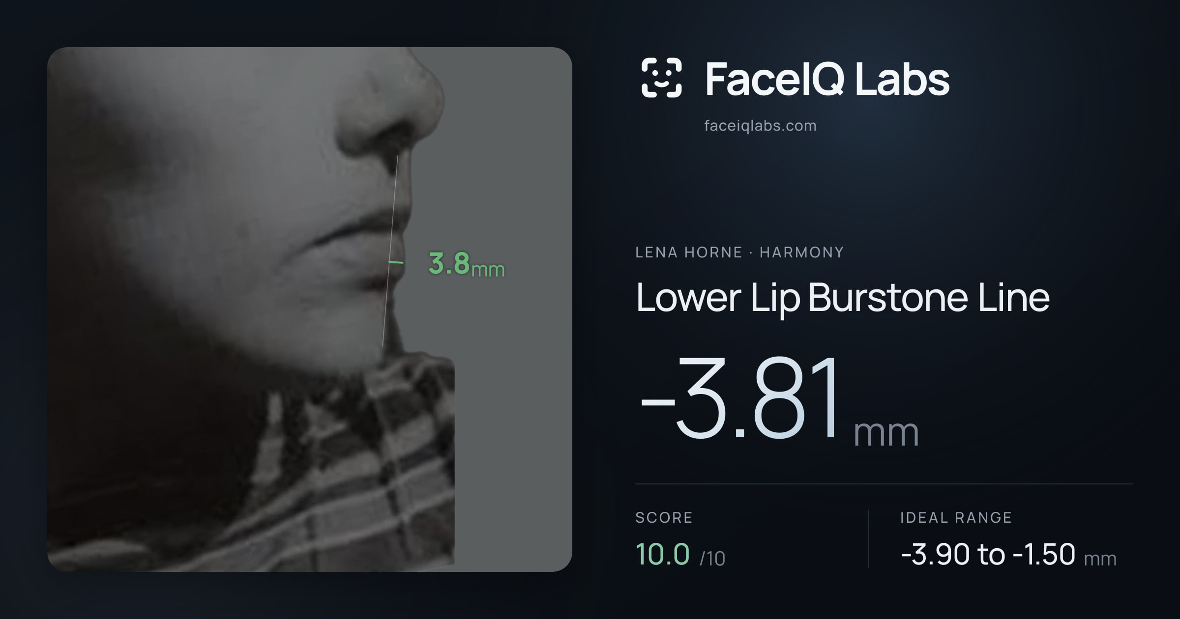 Lena Horne Lower Lip Burstone Line: -3.81mm, drawn on the photo