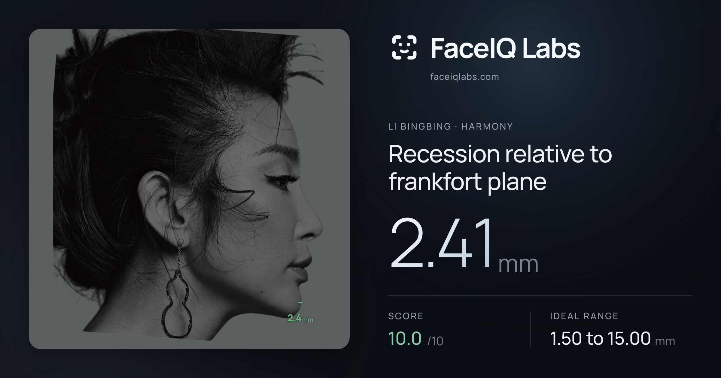 Li Bingbing Recession relative to frankfort plane: 2.41mm, drawn on the photo