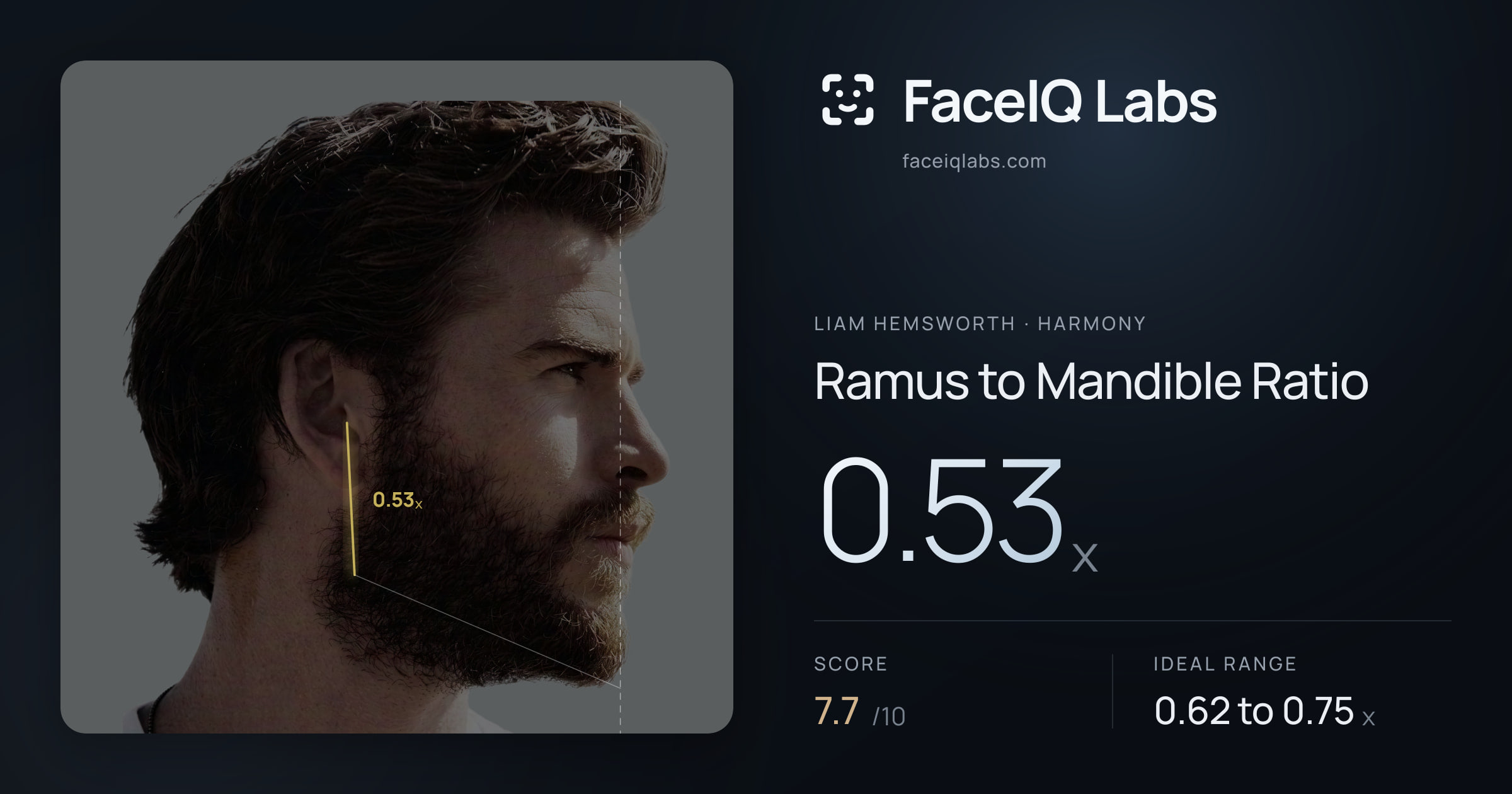 Liam Hemsworth Ramus to Mandible Ratio: 0.53x, drawn on the photo