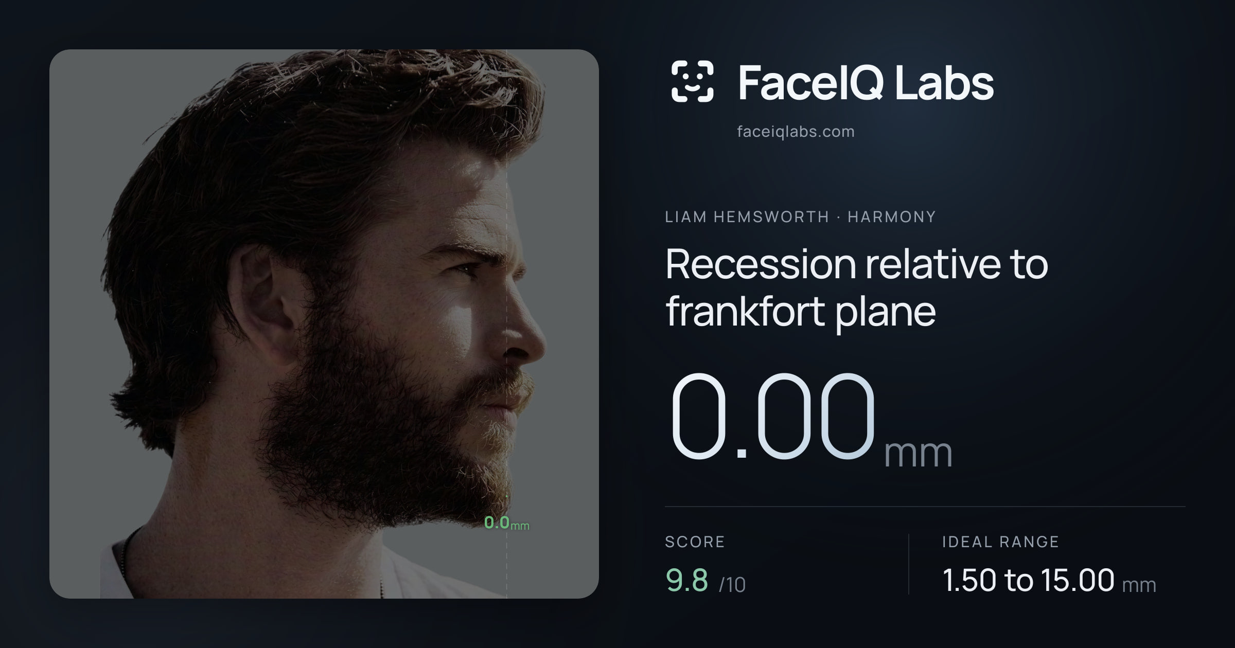 Liam Hemsworth Recession relative to frankfort plane: 0.00mm, drawn on the photo