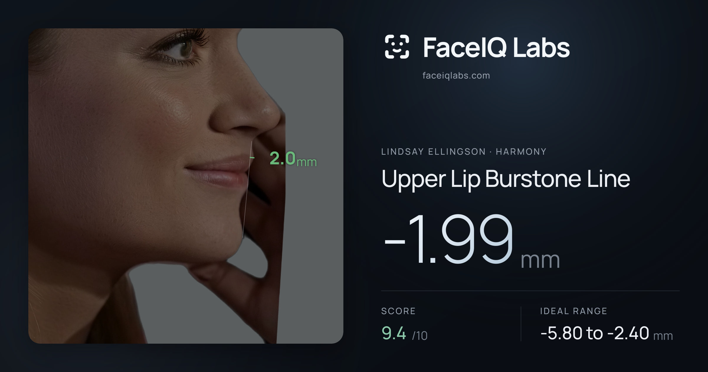 Lindsay Ellingson Upper Lip Burstone Line: -1.99mm, drawn on the photo