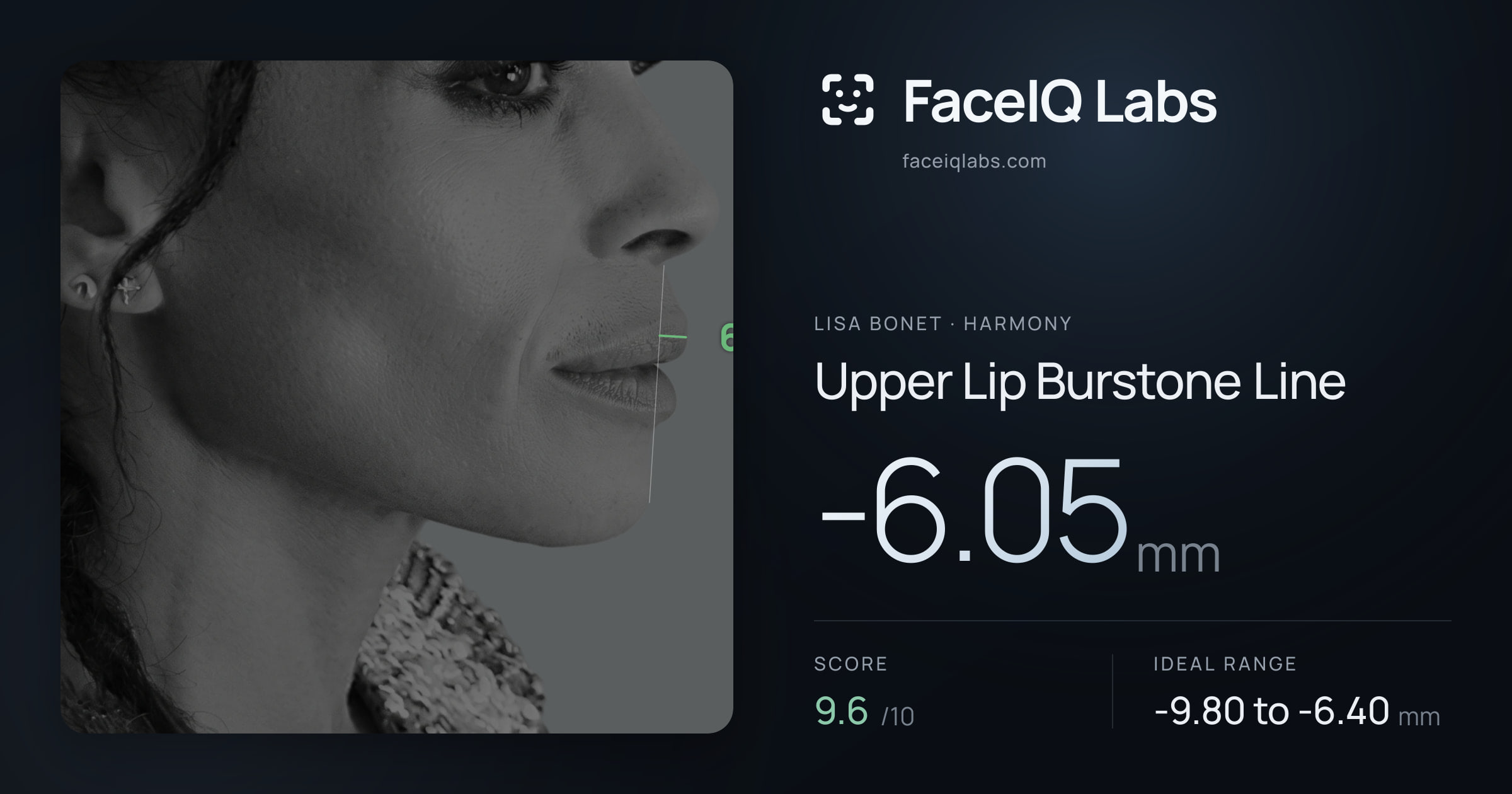 Lisa Bonet Upper Lip Burstone Line: -6.05mm, drawn on the photo
