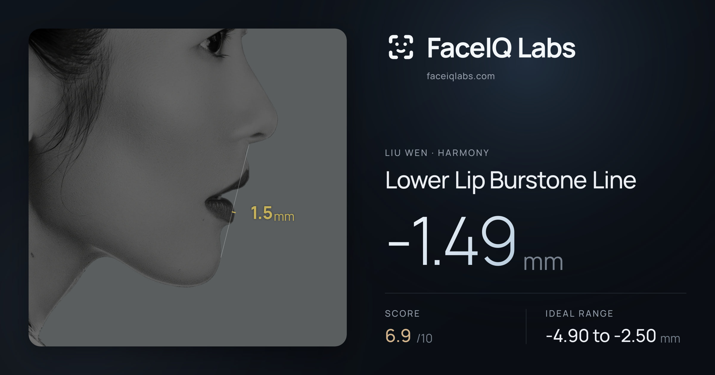 Liu Wen Lower Lip Burstone Line: -1.49mm, drawn on the photo