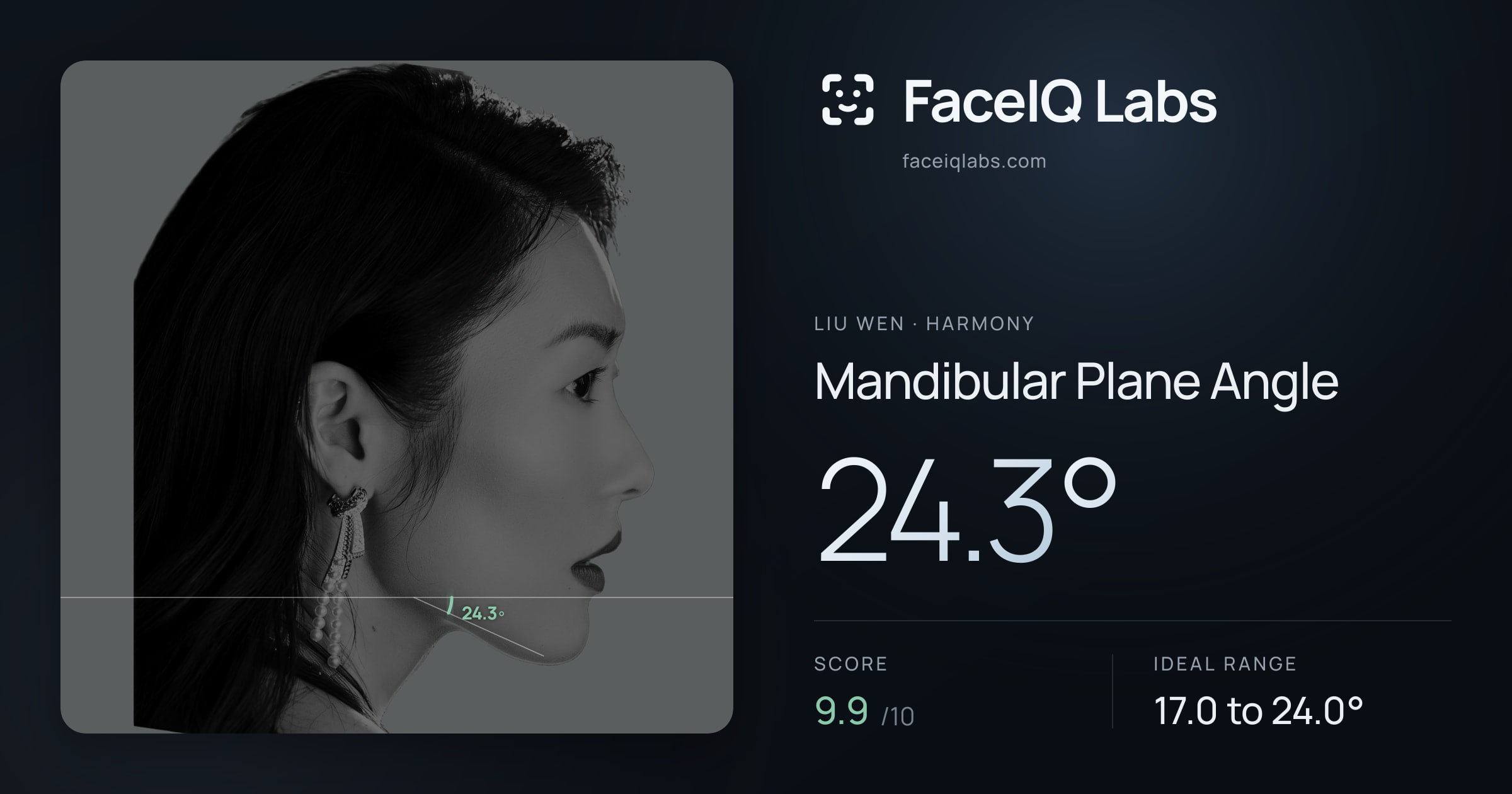 Liu Wen Mandibular Plane Angle: 24.3°, drawn on the photo