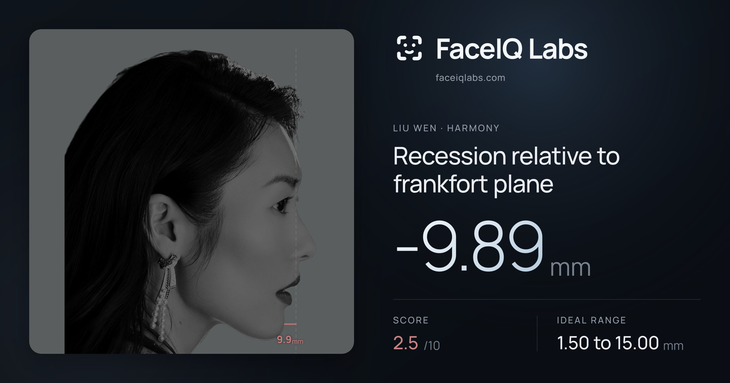 Liu Wen Recession relative to frankfort plane: -9.89mm, drawn on the photo