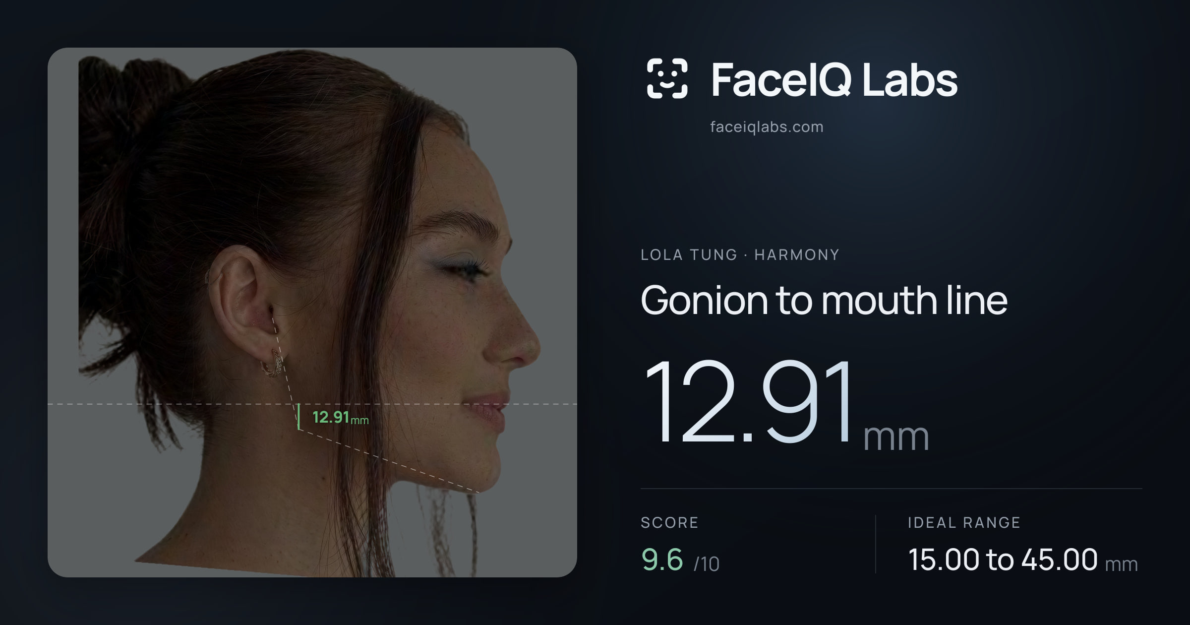 Lola Tung Gonion to mouth line: 12.91mm, drawn on the photo