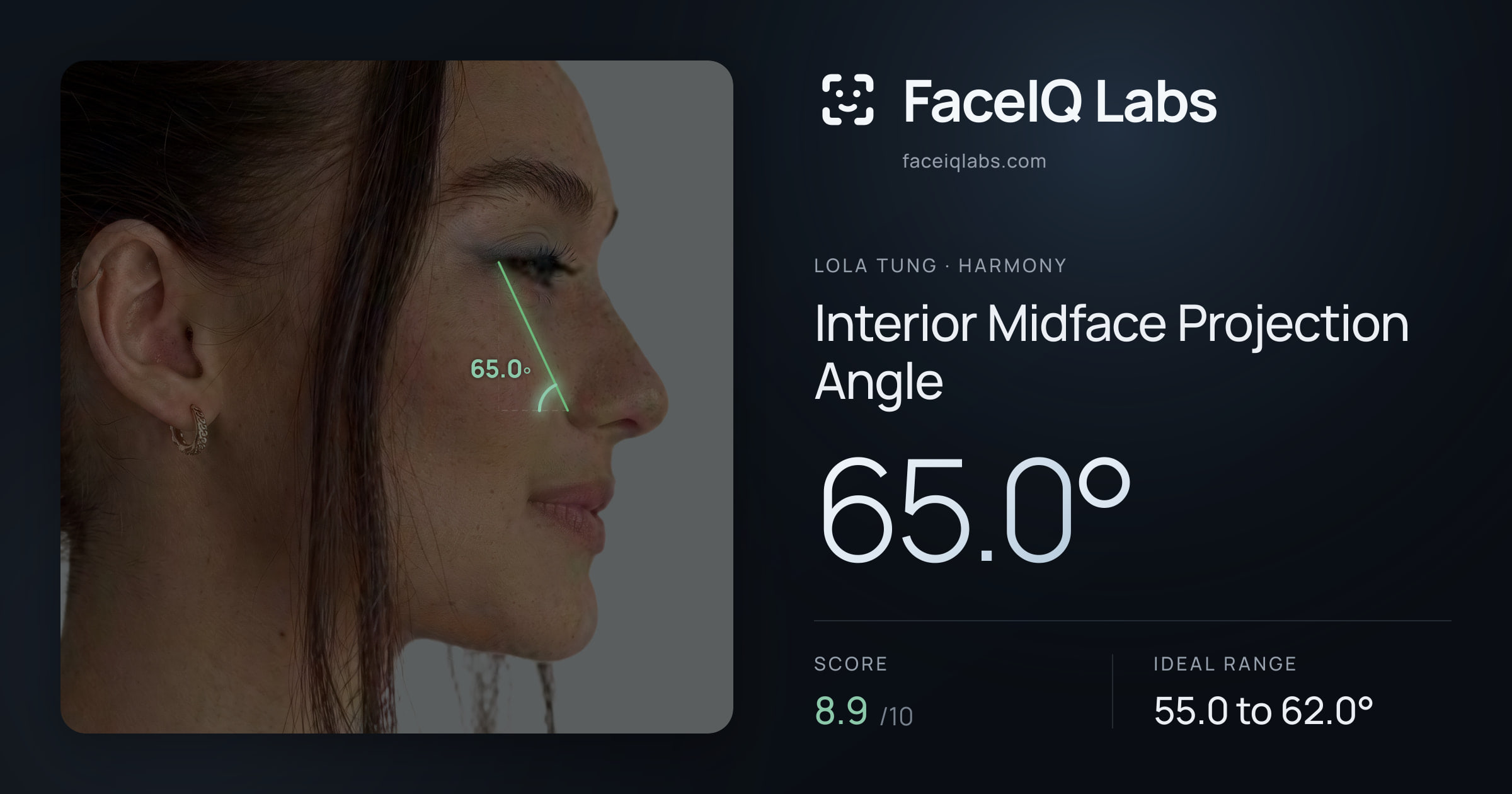 Lola Tung Interior Midface Projection Angle: 65.0°, drawn on the photo
