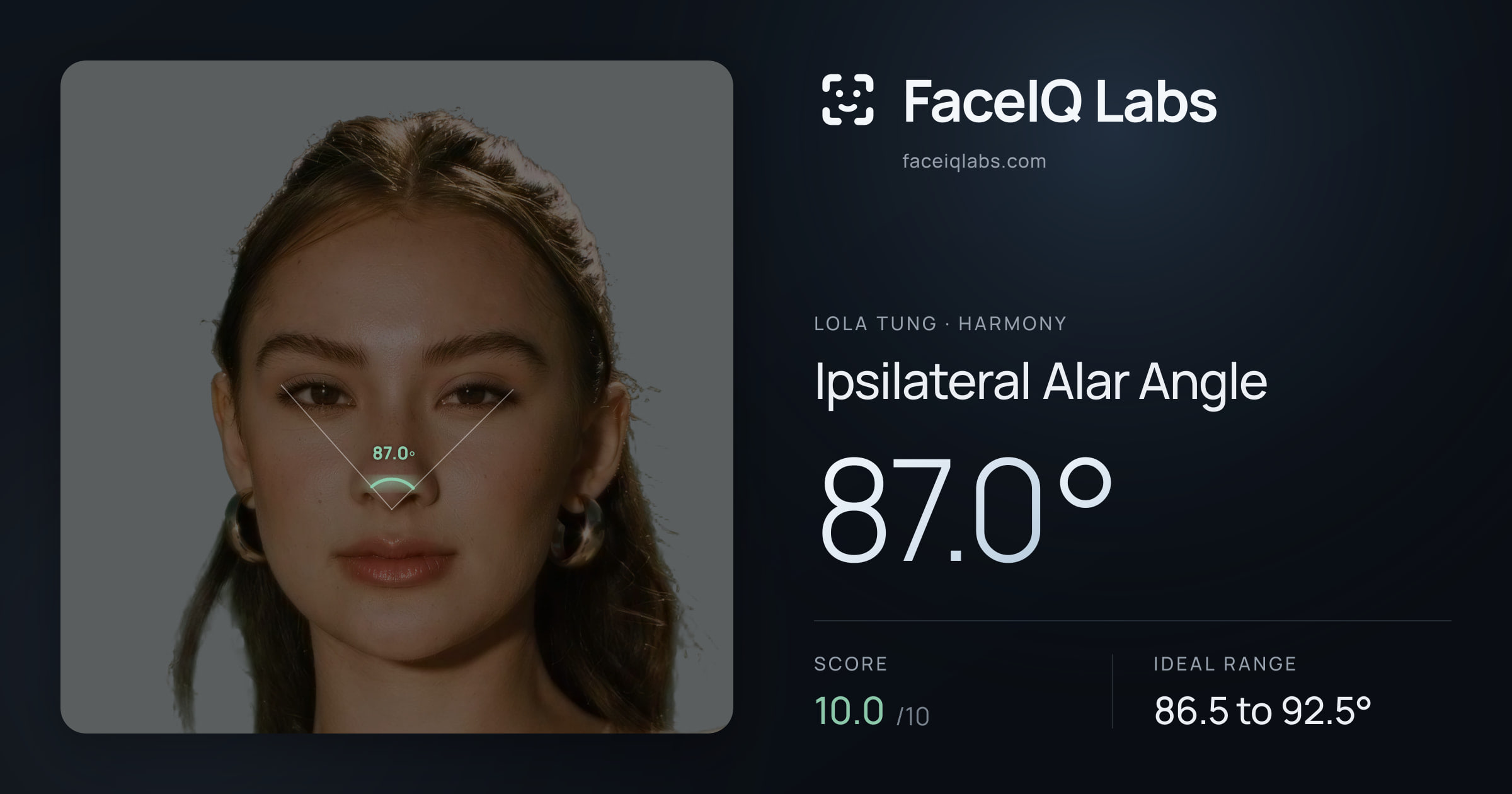Lola Tung Ipsilateral Alar Angle: 87.0°, drawn on the photo