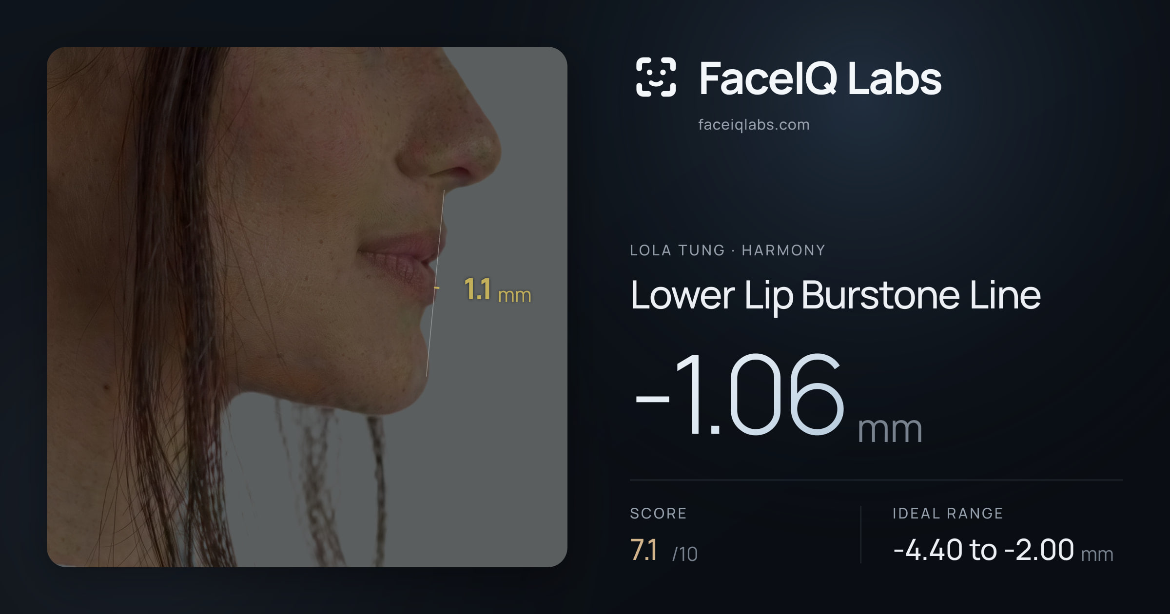 Lola Tung Lower Lip Burstone Line: -1.06mm, drawn on the photo