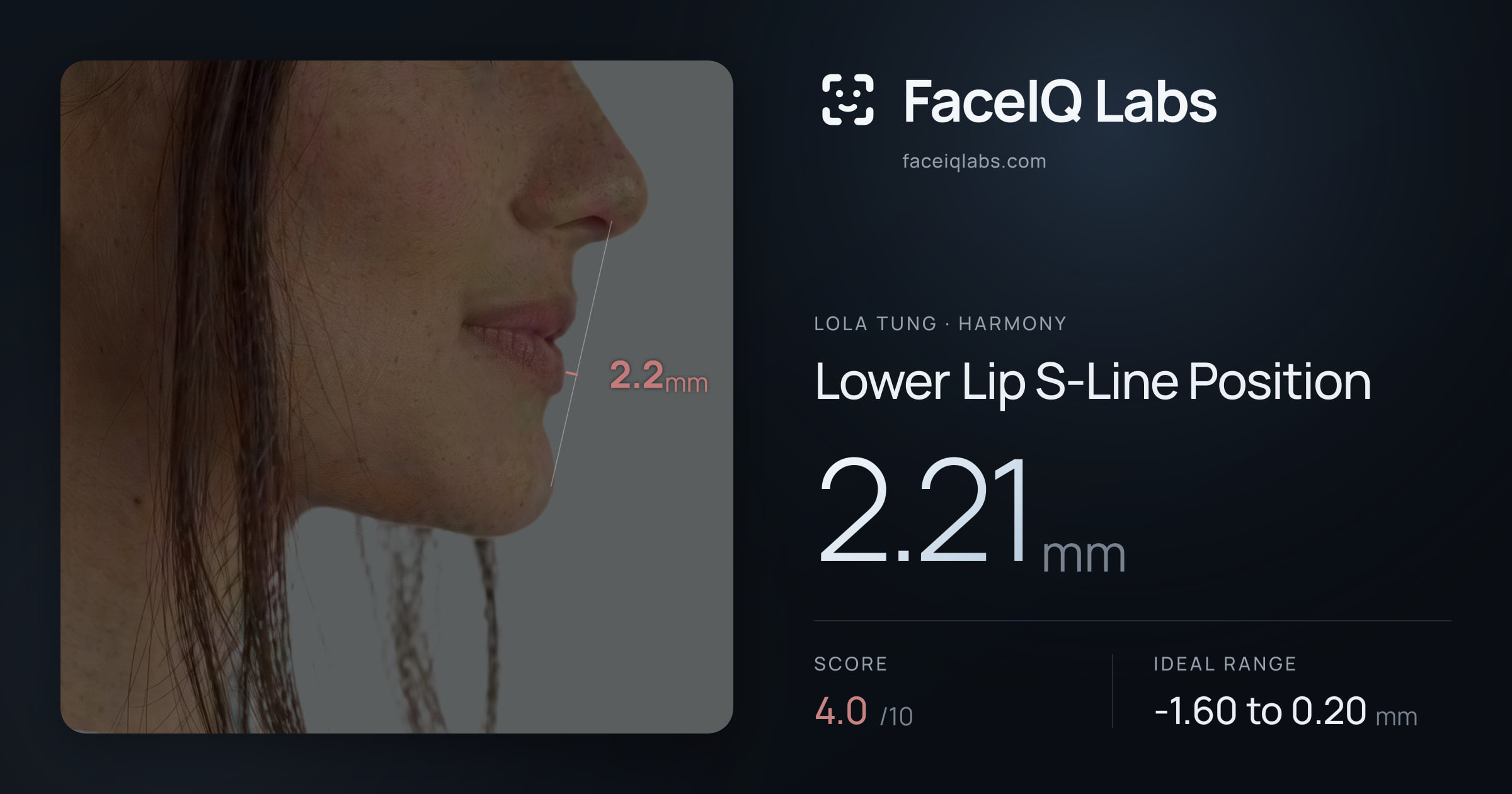 Lola Tung Lower Lip S-Line Position: 2.21mm, drawn on the photo