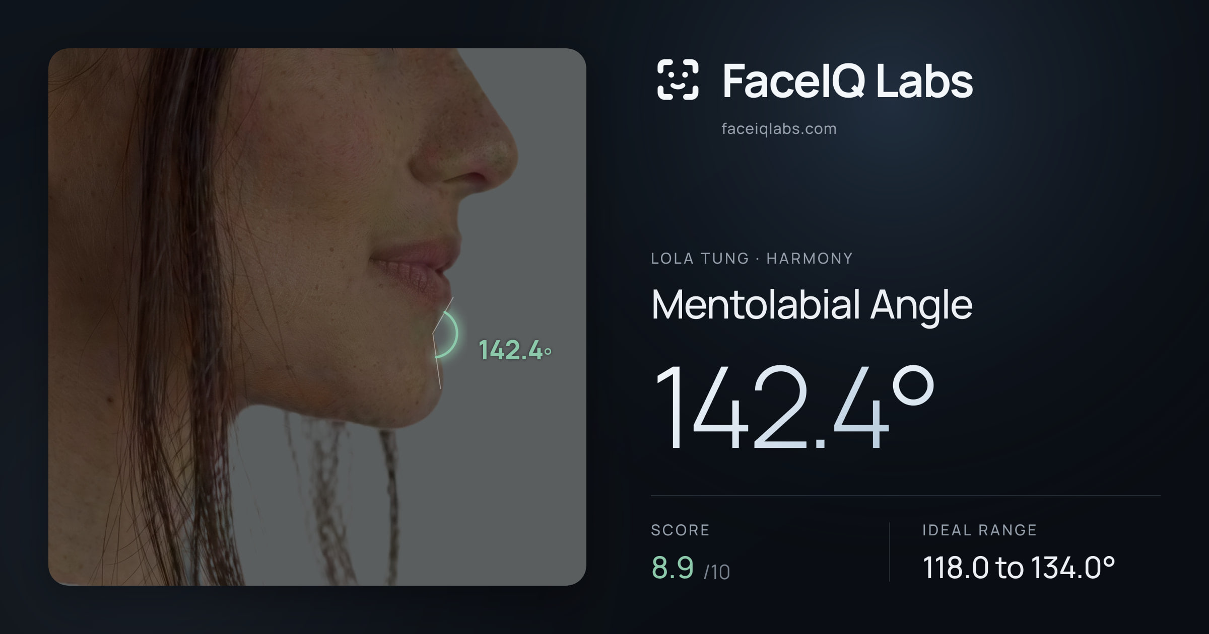 Lola Tung Mentolabial Angle: 142.4°, drawn on the photo