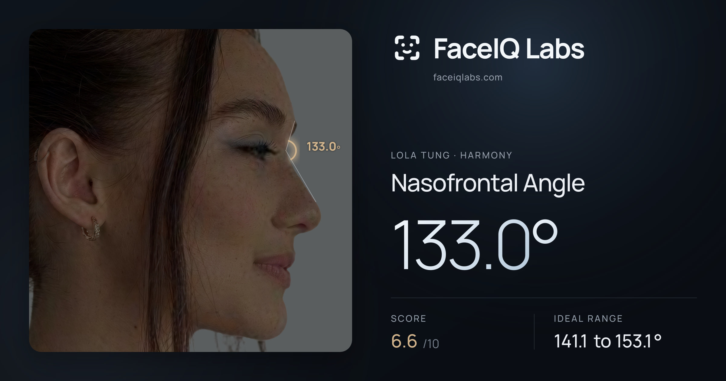 Lola Tung Nasofrontal Angle: 133.0°, drawn on the photo