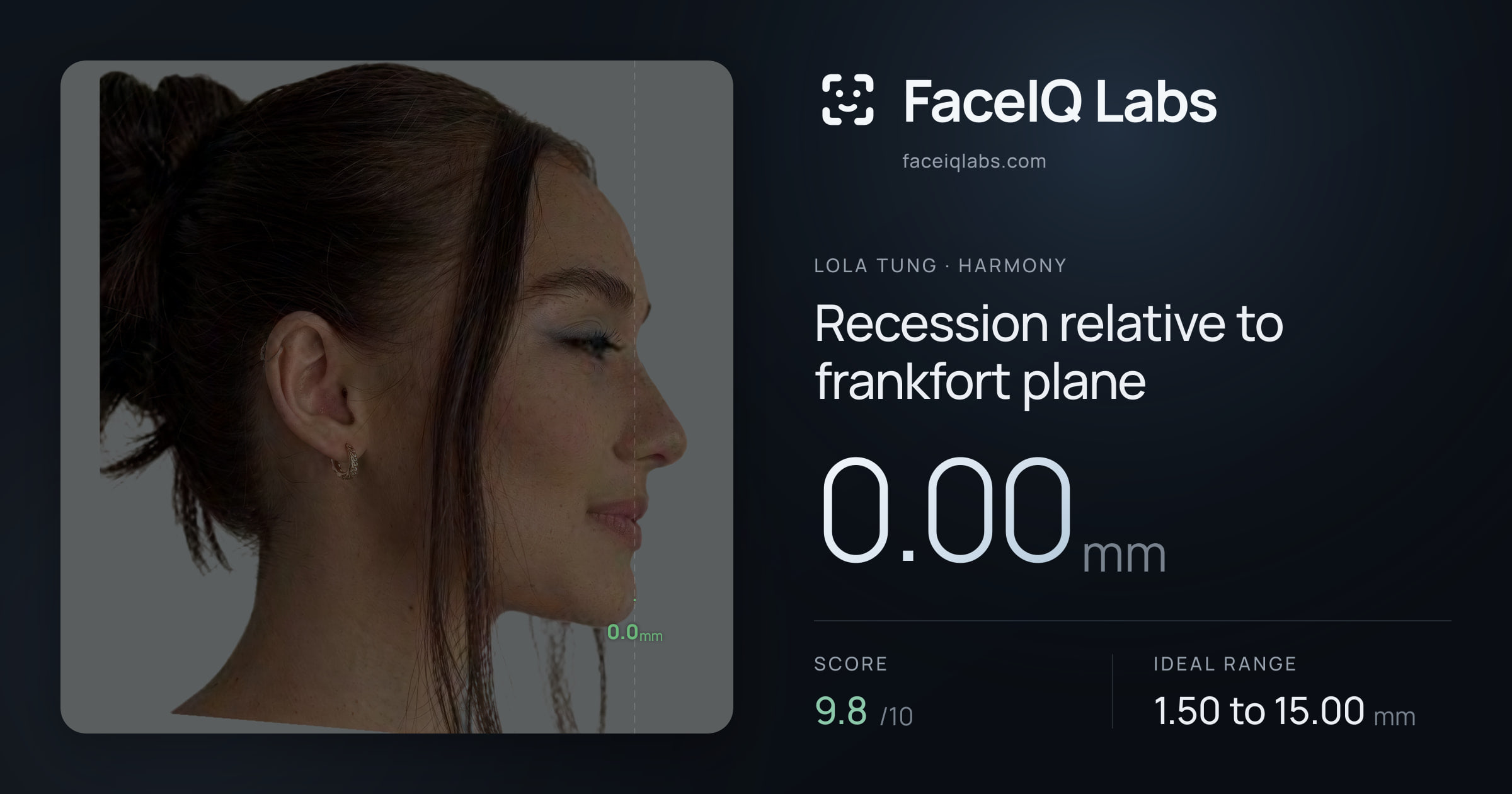 Lola Tung Recession relative to frankfort plane: 0.00mm, drawn on the photo