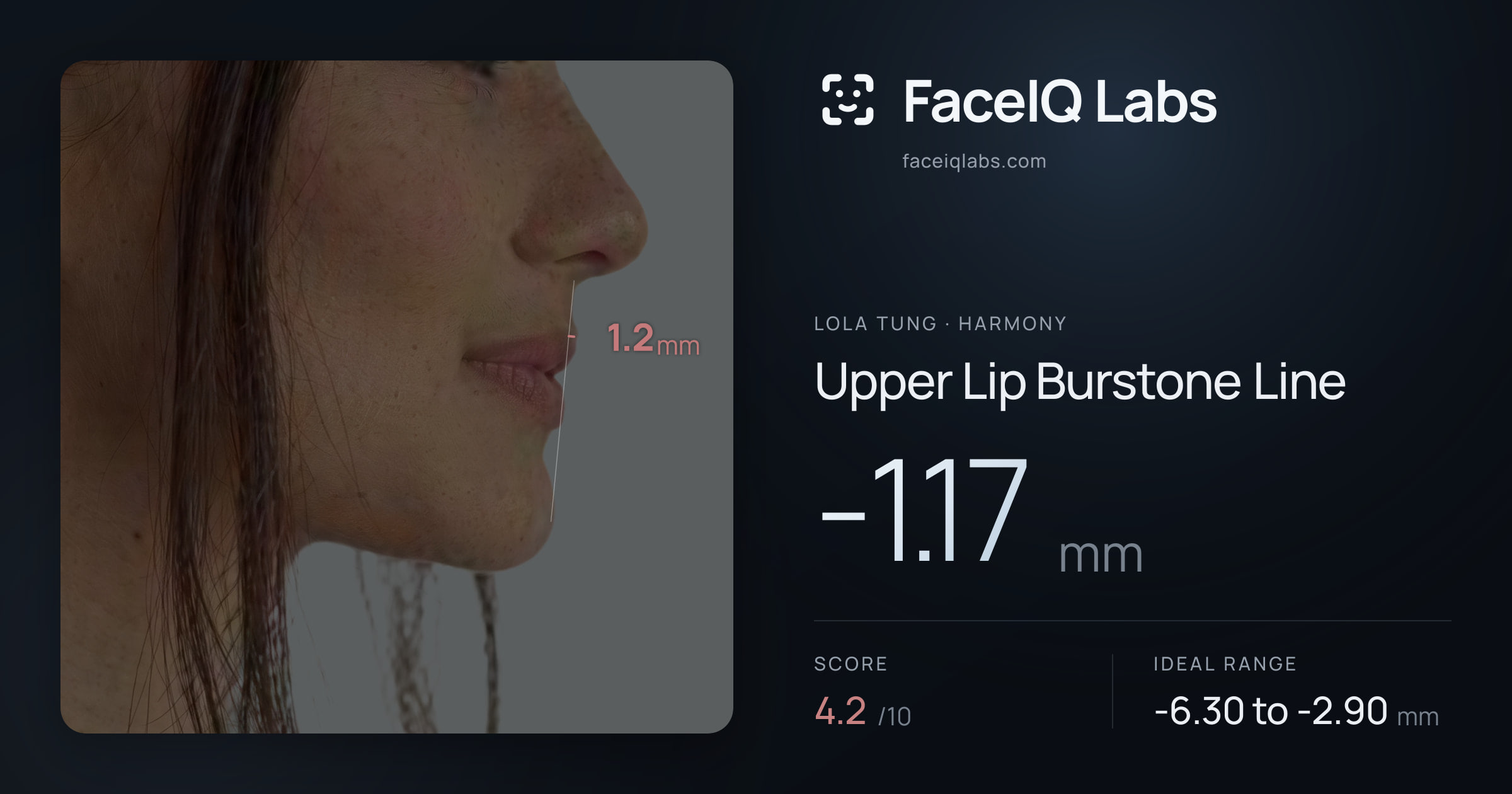Lola Tung Upper Lip Burstone Line: -1.17mm, drawn on the photo
