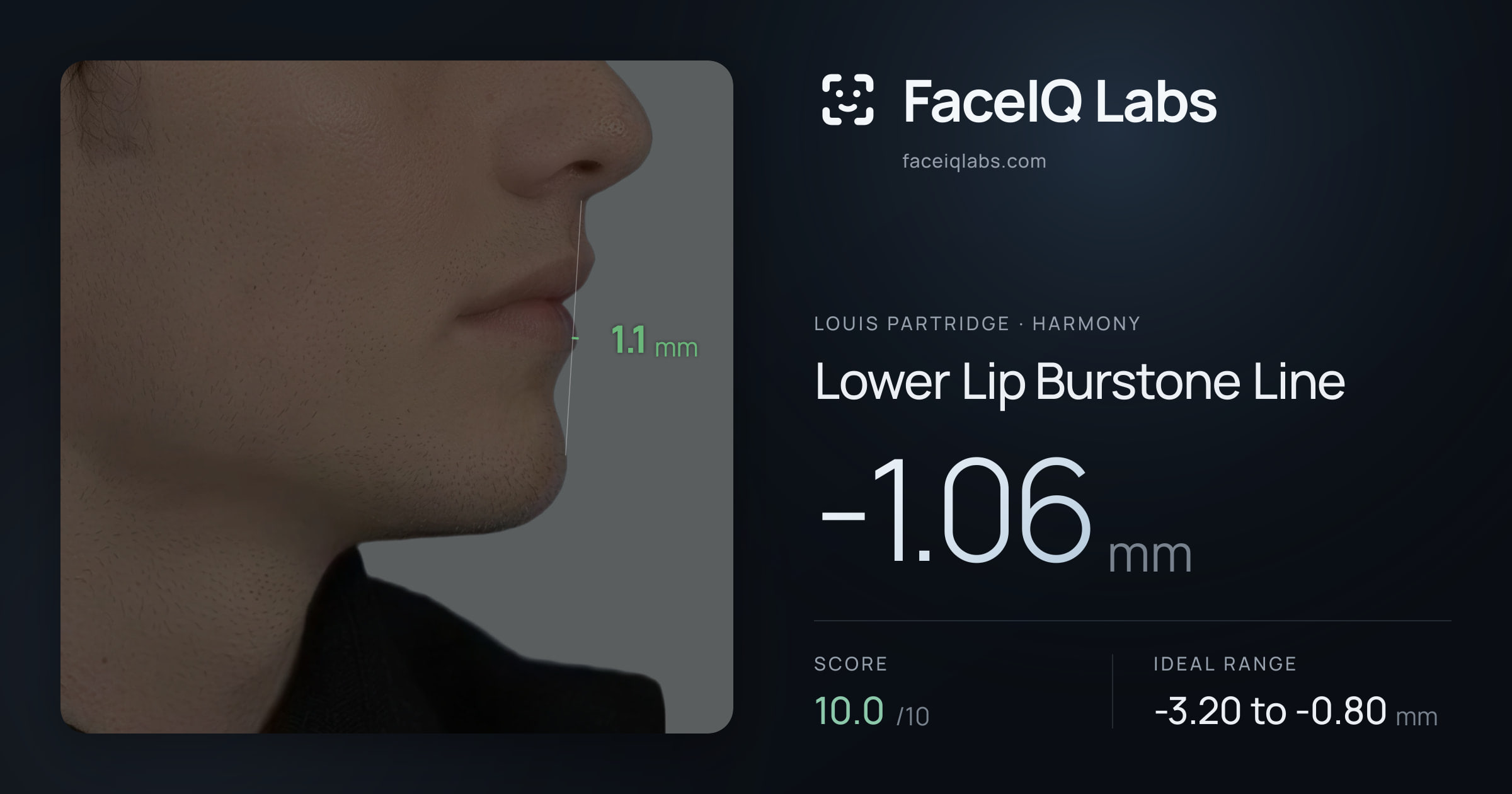 Louis Partridge Lower Lip Burstone Line: -1.06mm, drawn on the photo