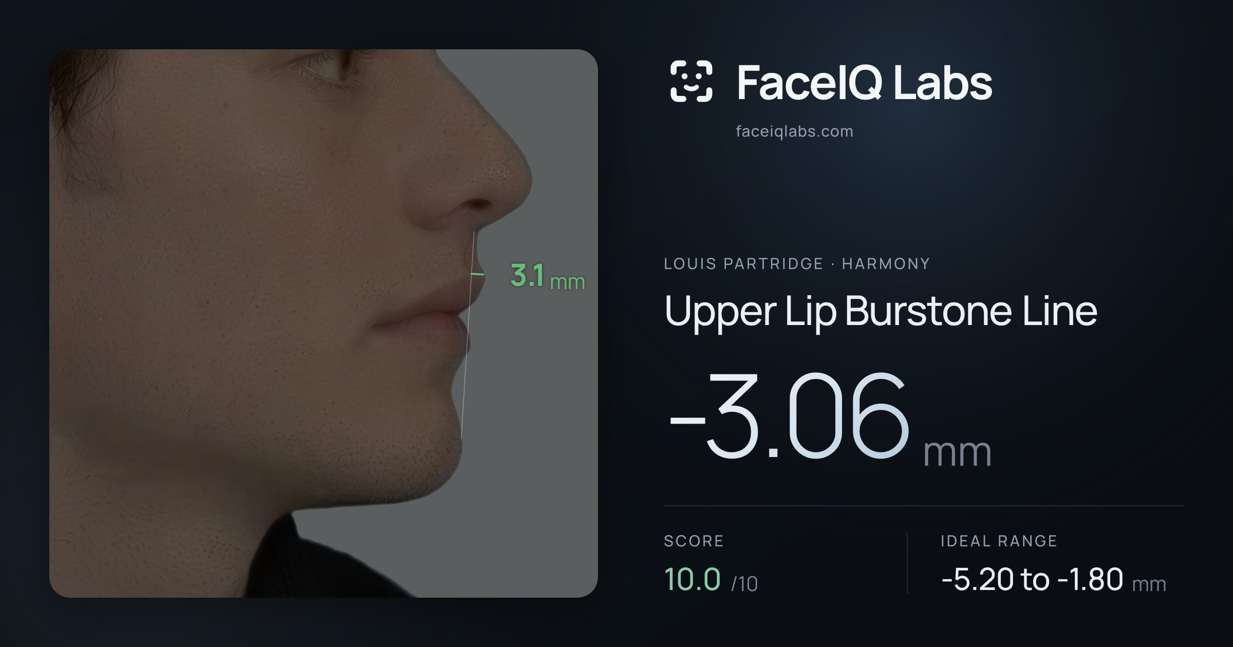 Louis Partridge Upper Lip Burstone Line: -3.06mm, drawn on the photo