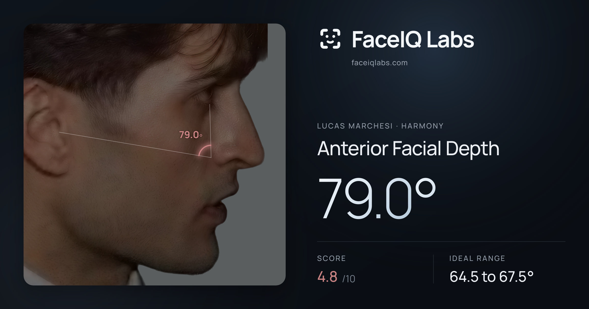 Lucas Marchesi Anterior Facial Depth: 79.0°, drawn on the photo