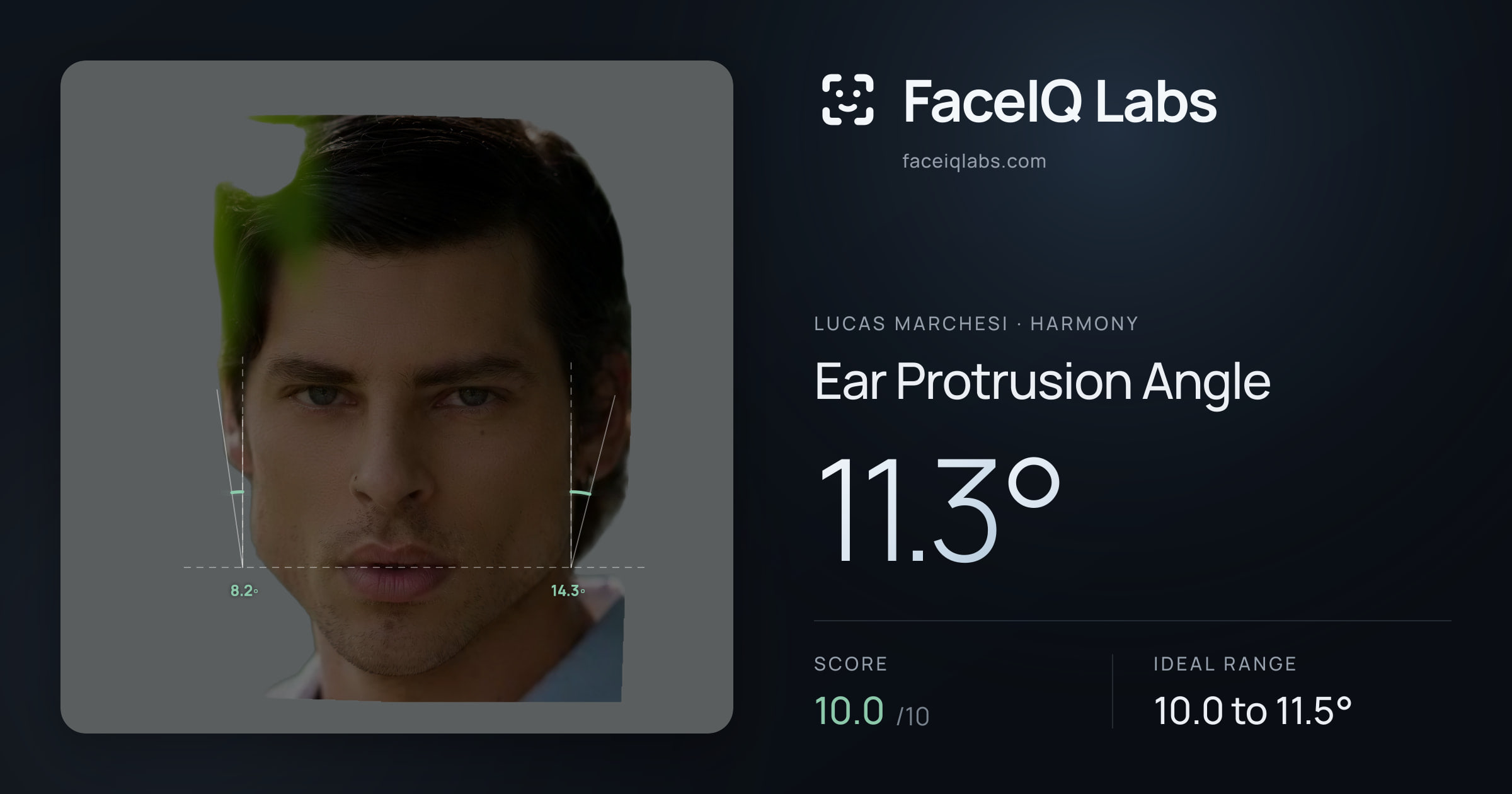 Lucas Marchesi Ear Protrusion Angle: 11.3°, drawn on the photo