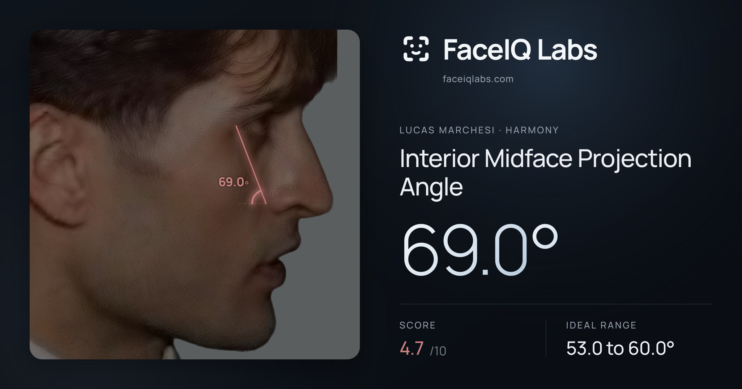 Lucas Marchesi Interior Midface Projection Angle: 69.0°, drawn on the photo