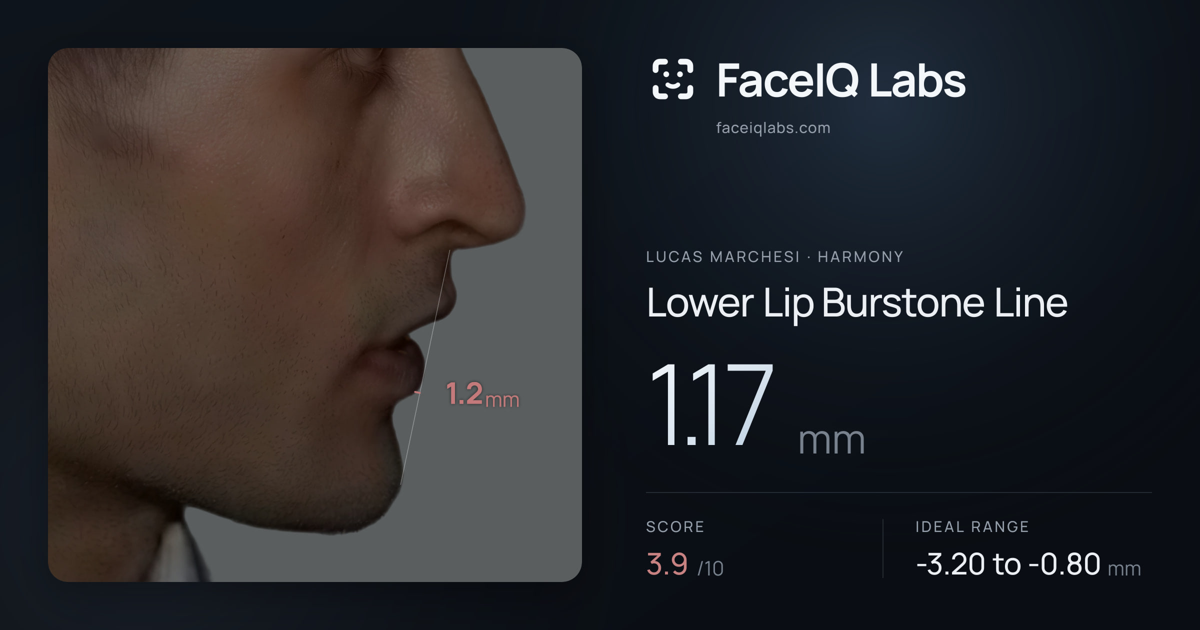 Lucas Marchesi Lower Lip Burstone Line: 1.17mm, drawn on the photo