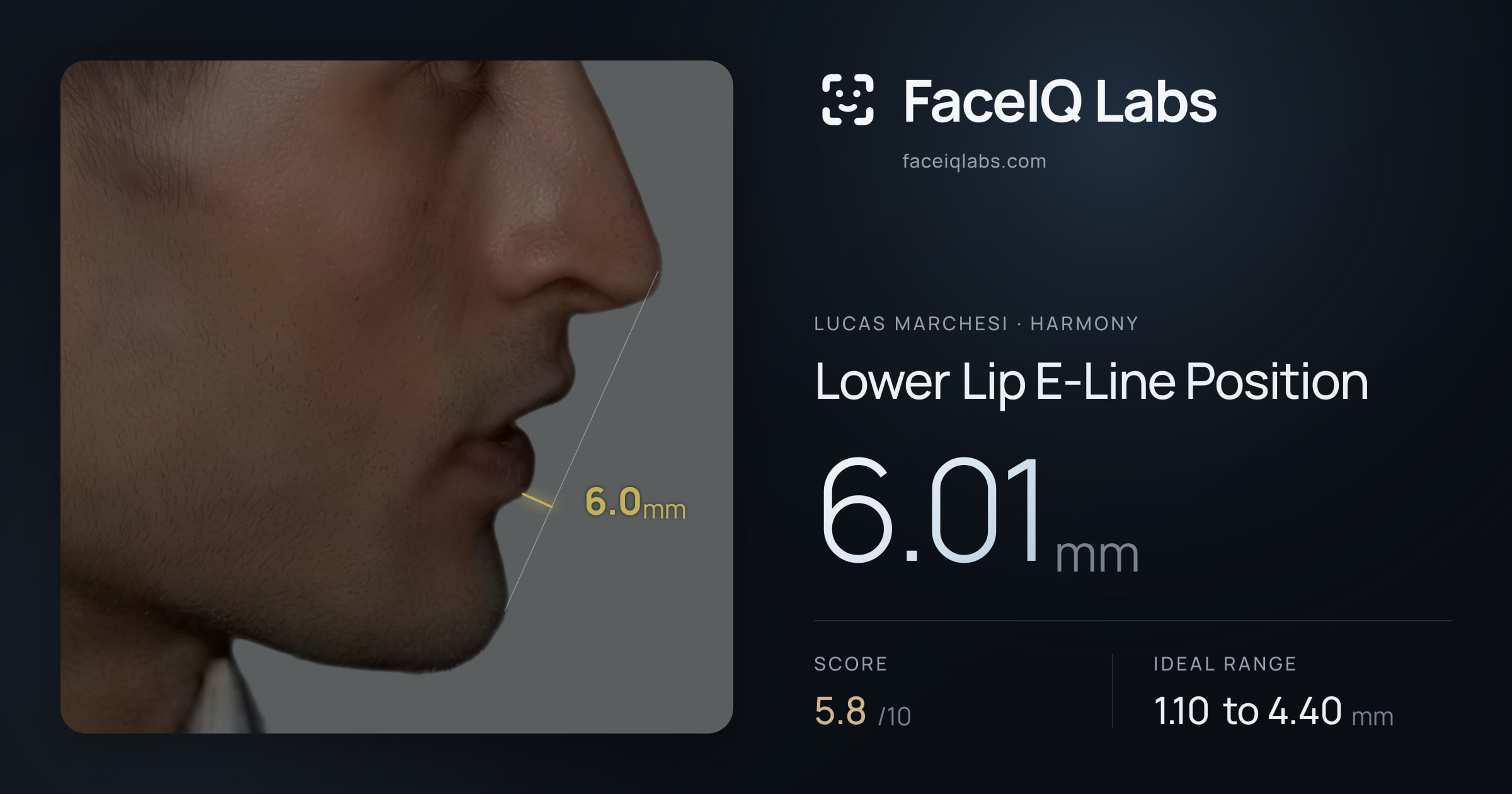 Lucas Marchesi Lower Lip E-Line Position: 6.01mm, drawn on the photo