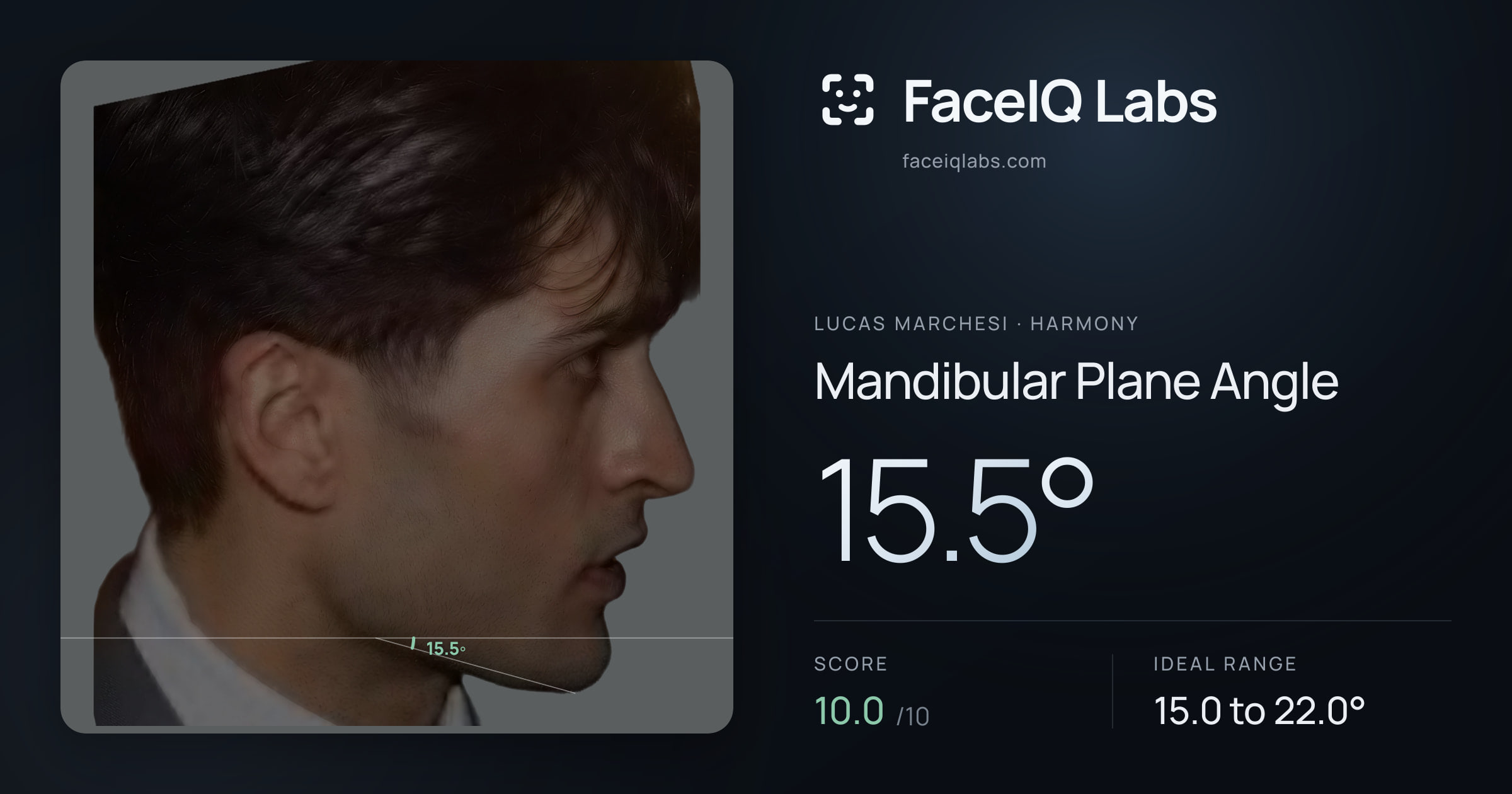 Lucas Marchesi Mandibular Plane Angle: 15.5°, drawn on the photo