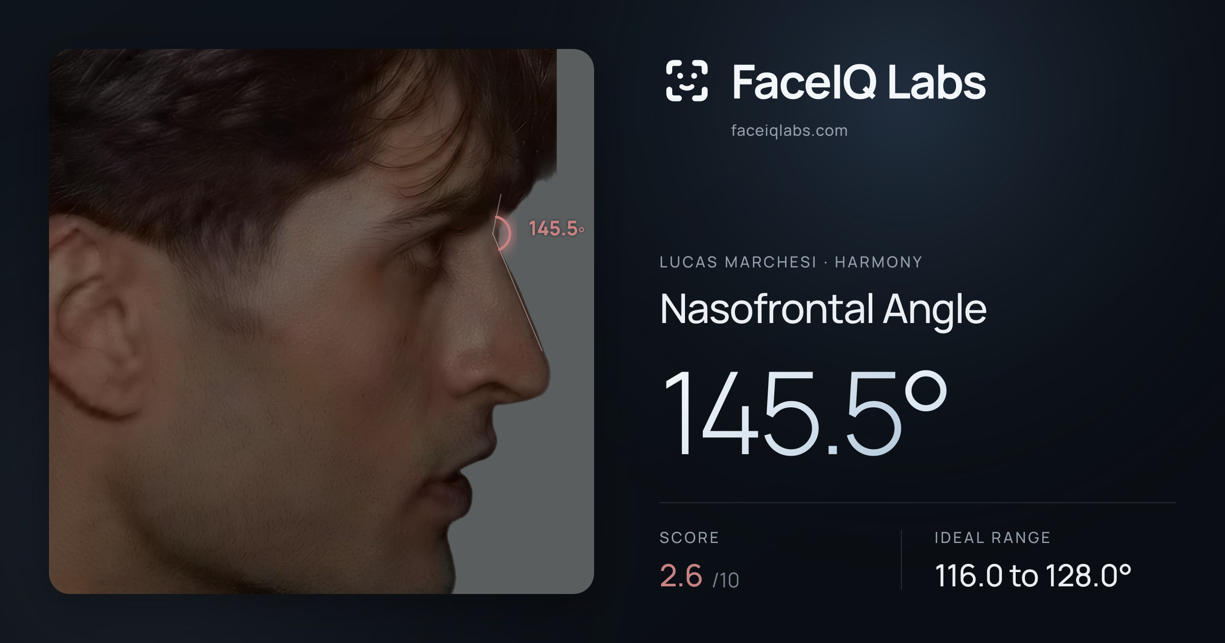 Lucas Marchesi Nasofrontal Angle: 145.5°, drawn on the photo