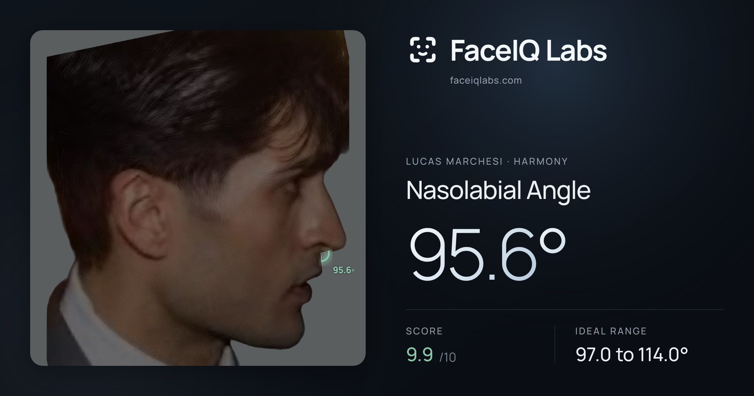 Lucas Marchesi Nasolabial Angle: 95.6°, drawn on the photo