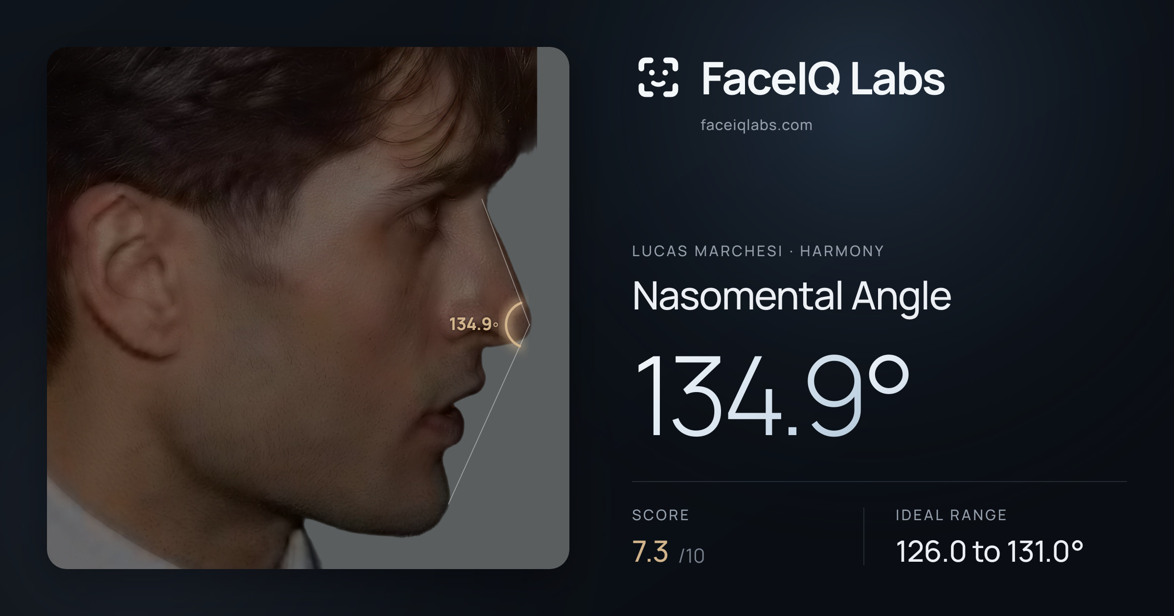 Lucas Marchesi Nasomental Angle: 134.9°, drawn on the photo