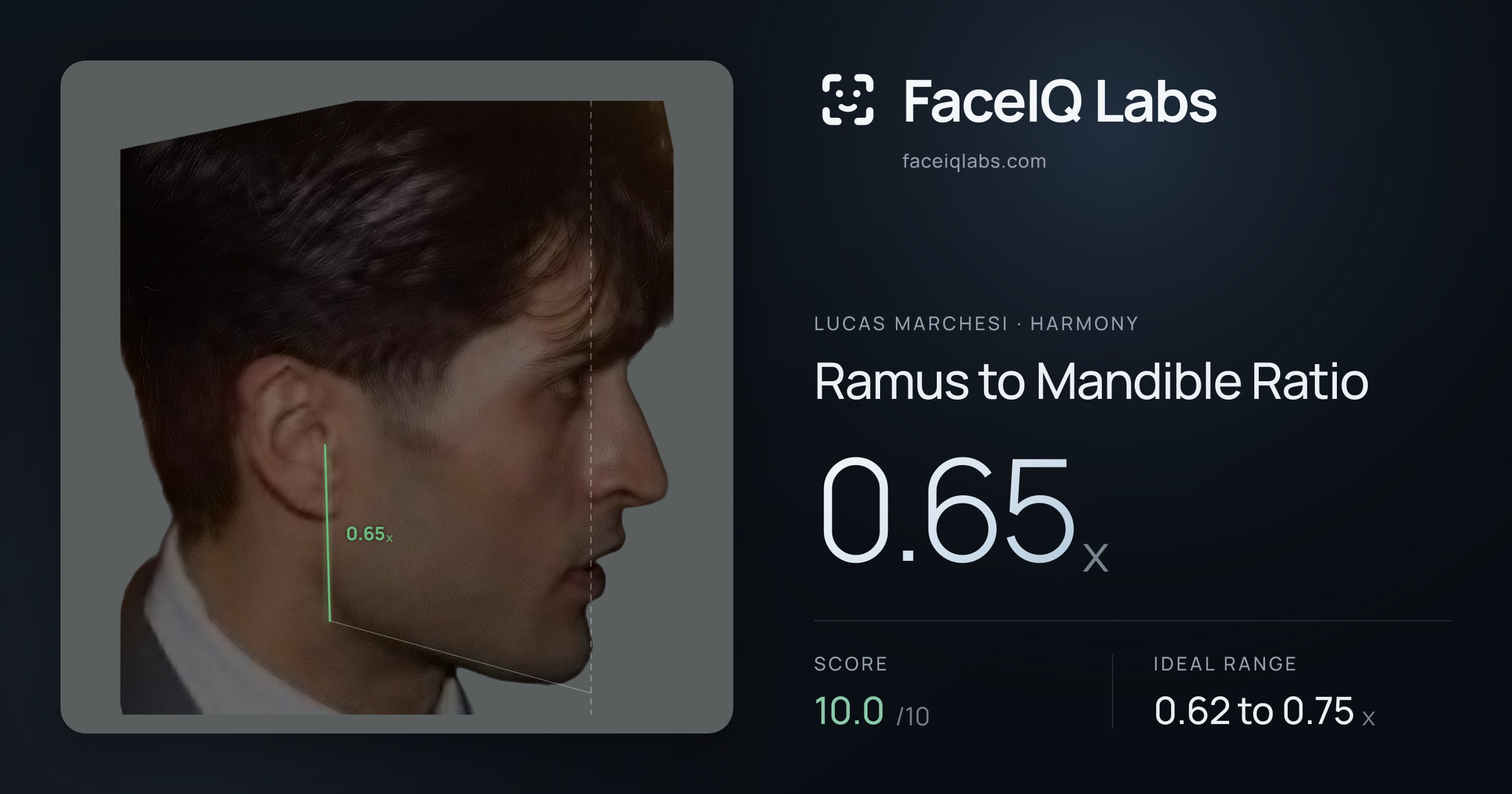 Lucas Marchesi Ramus to Mandible Ratio: 0.65x, drawn on the photo