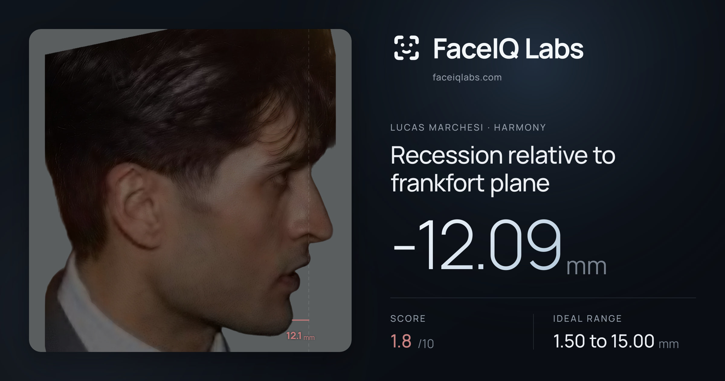 Lucas Marchesi Recession relative to frankfort plane: -12.09mm, drawn on the photo
