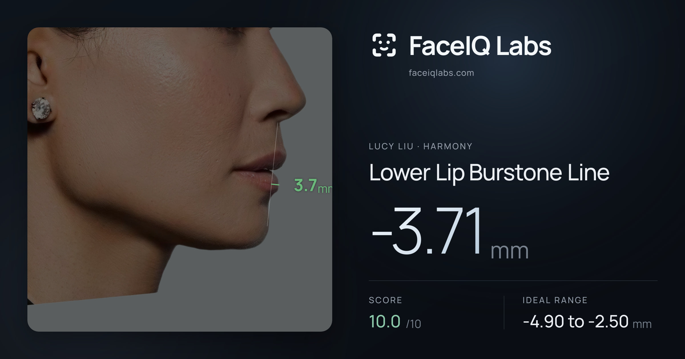 Lucy Liu Lower Lip Burstone Line: -3.71mm, drawn on the photo