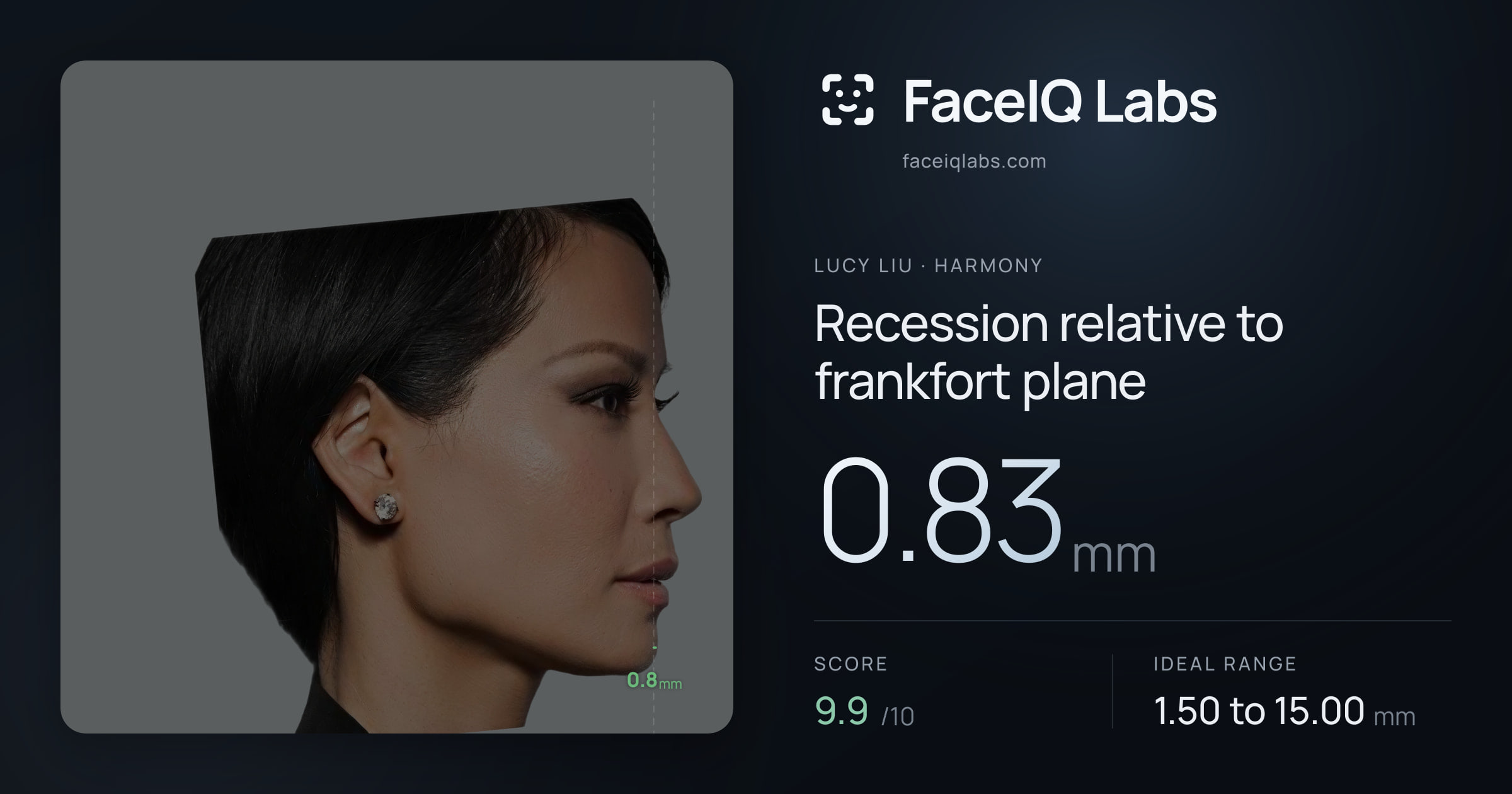 Lucy Liu Recession relative to frankfort plane: 0.83mm, drawn on the photo