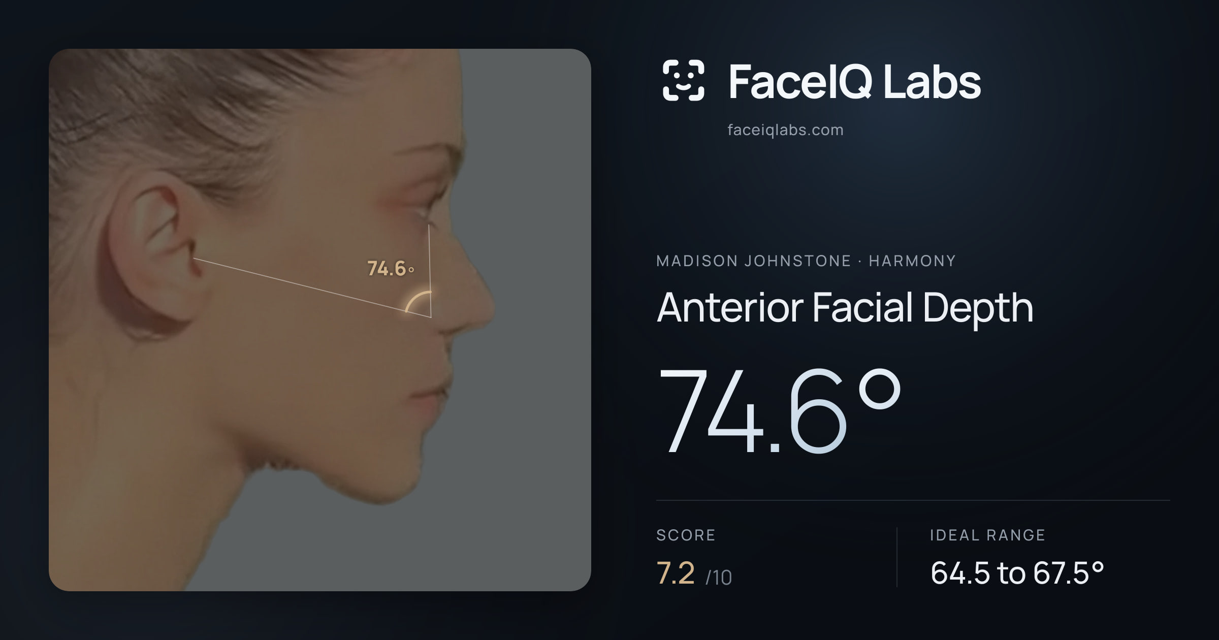 Madison Johnstone Anterior Facial Depth: 74.6°, drawn on the photo