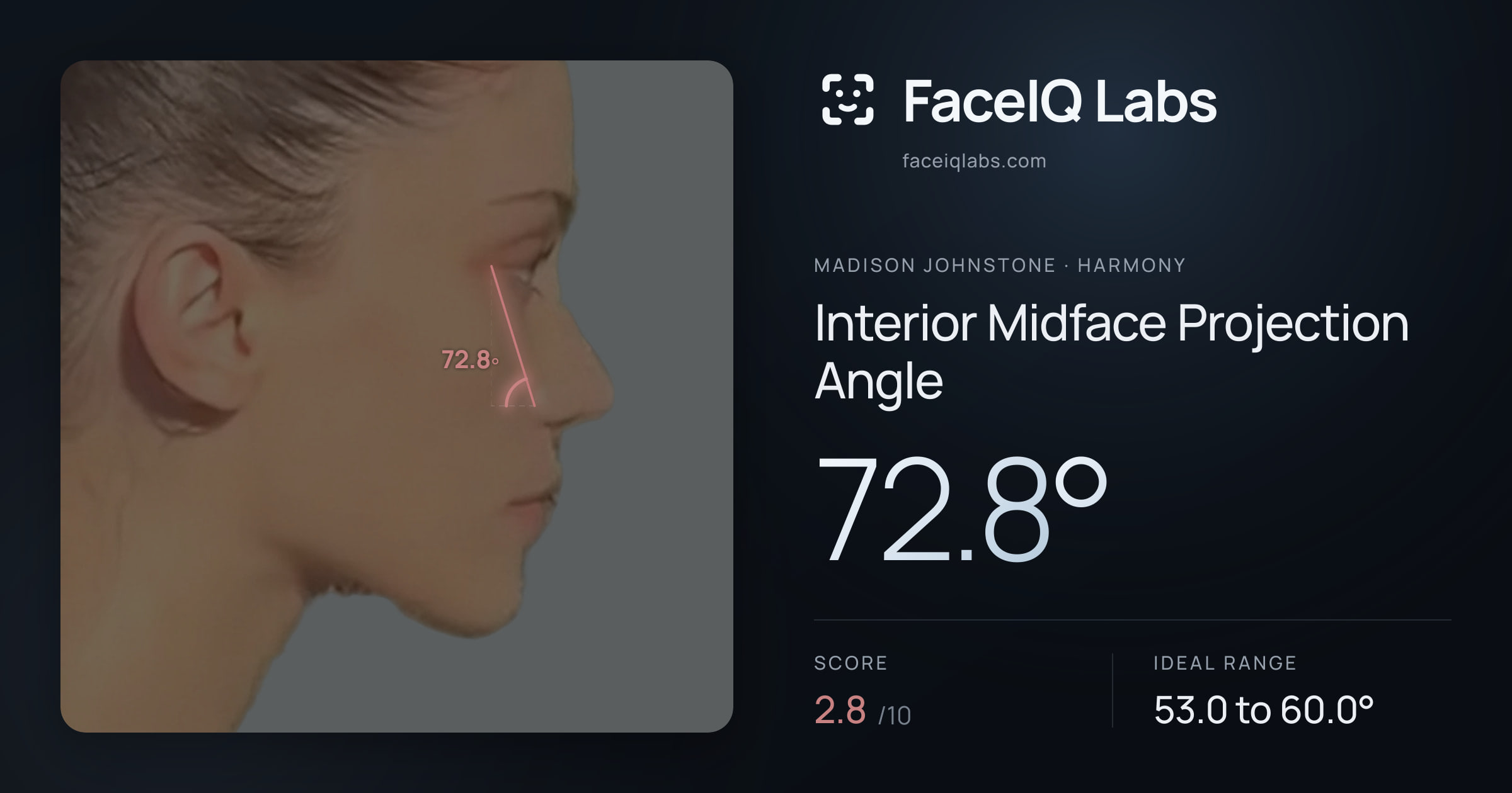Madison Johnstone Interior Midface Projection Angle: 72.8°, drawn on the photo