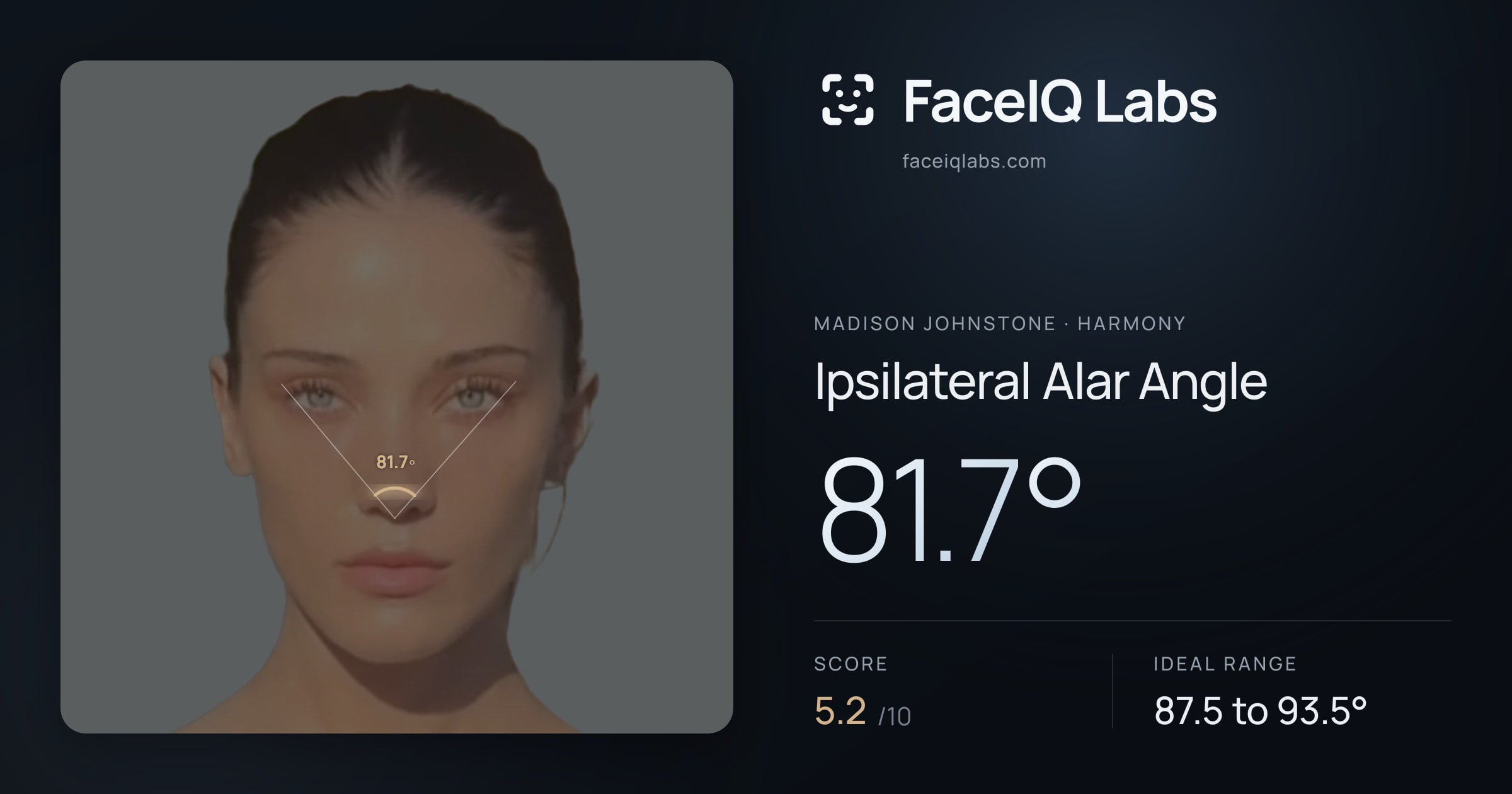 Madison Johnstone Ipsilateral Alar Angle: 81.7°, drawn on the photo