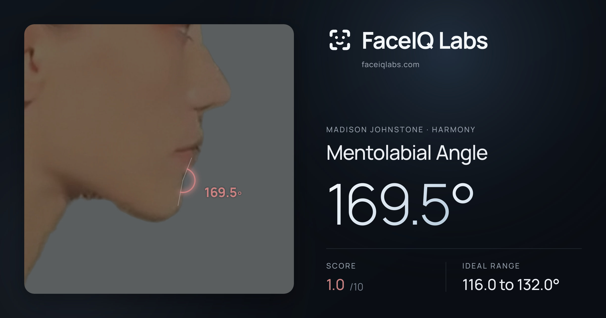 Madison Johnstone Mentolabial Angle: 169.5°, drawn on the photo