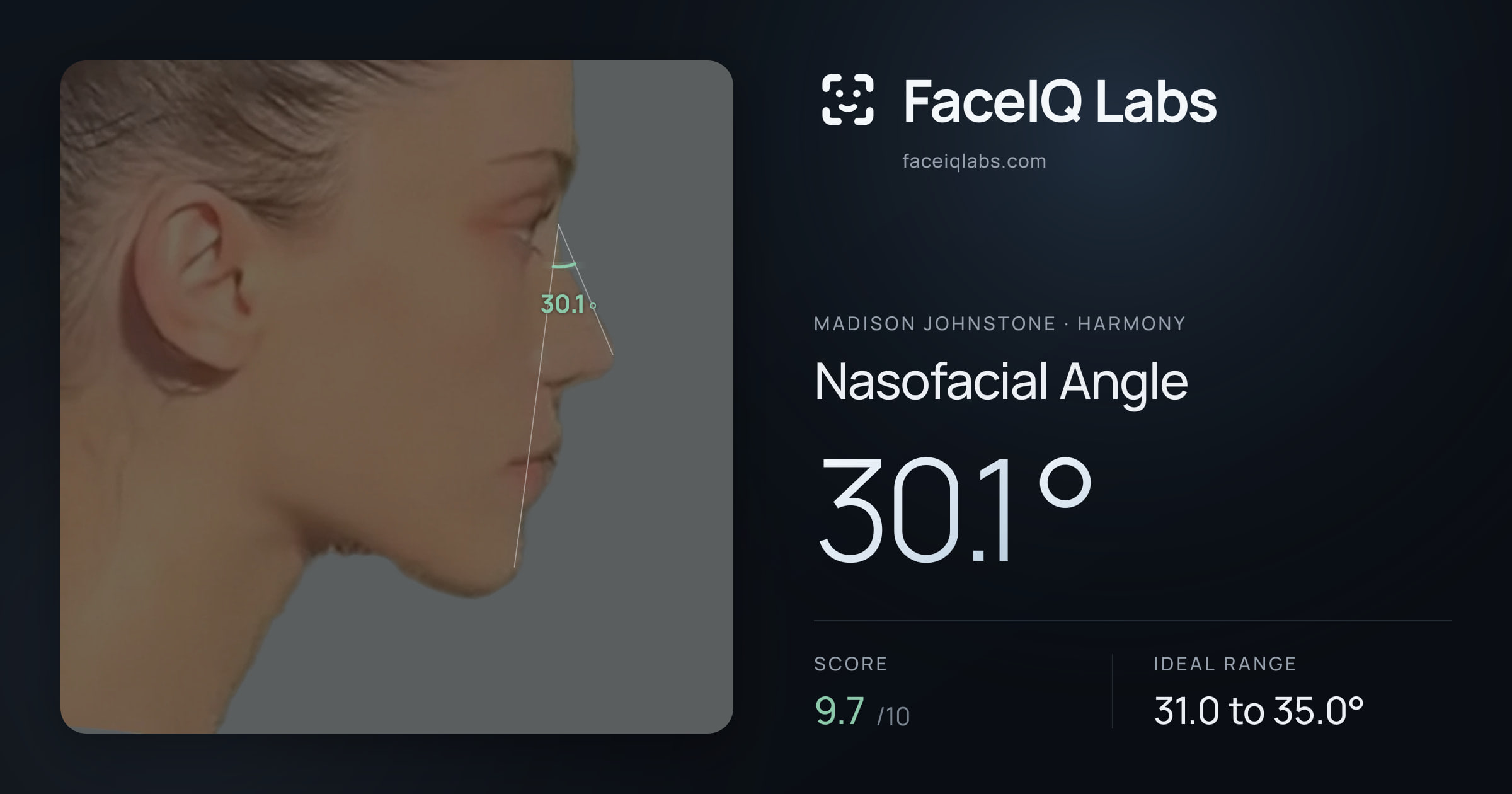 Madison Johnstone Nasofacial Angle: 30.1°, drawn on the photo