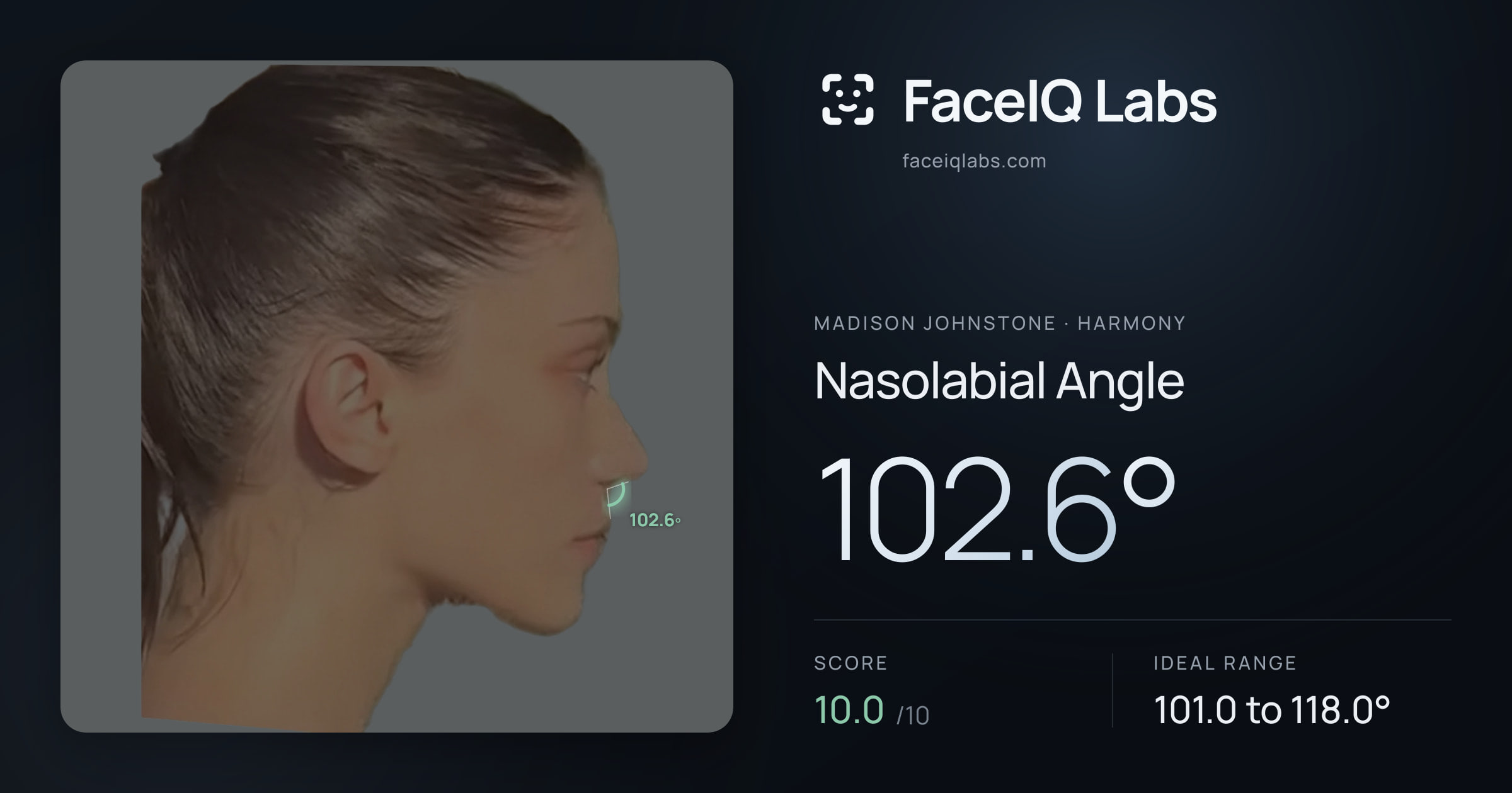 Madison Johnstone Nasolabial Angle: 102.6°, drawn on the photo