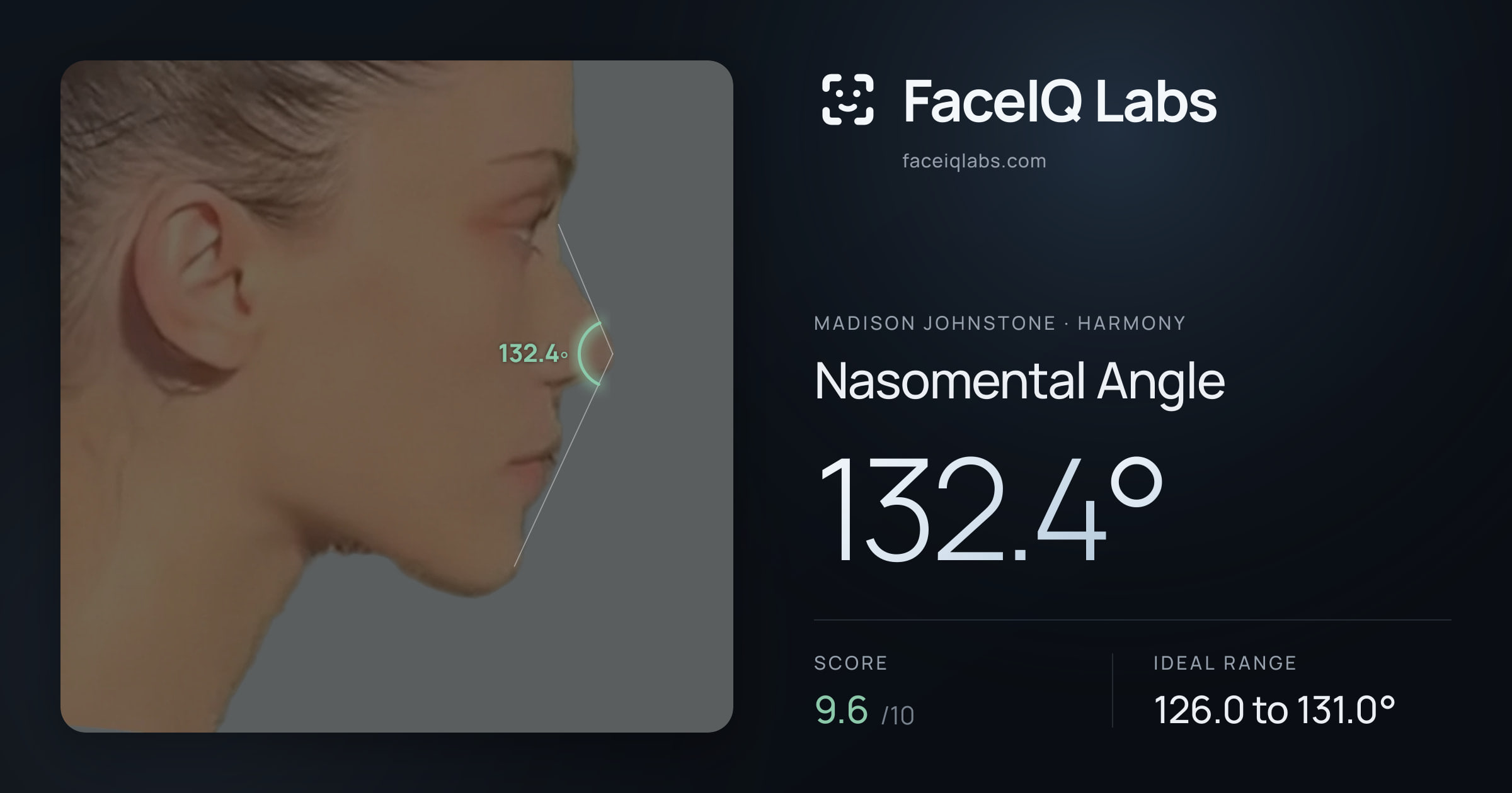 Madison Johnstone Nasomental Angle: 132.4°, drawn on the photo