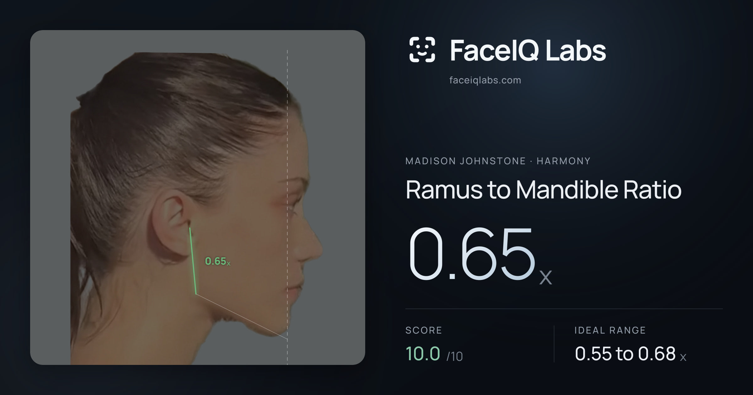 Madison Johnstone Ramus to Mandible Ratio: 0.65x, drawn on the photo