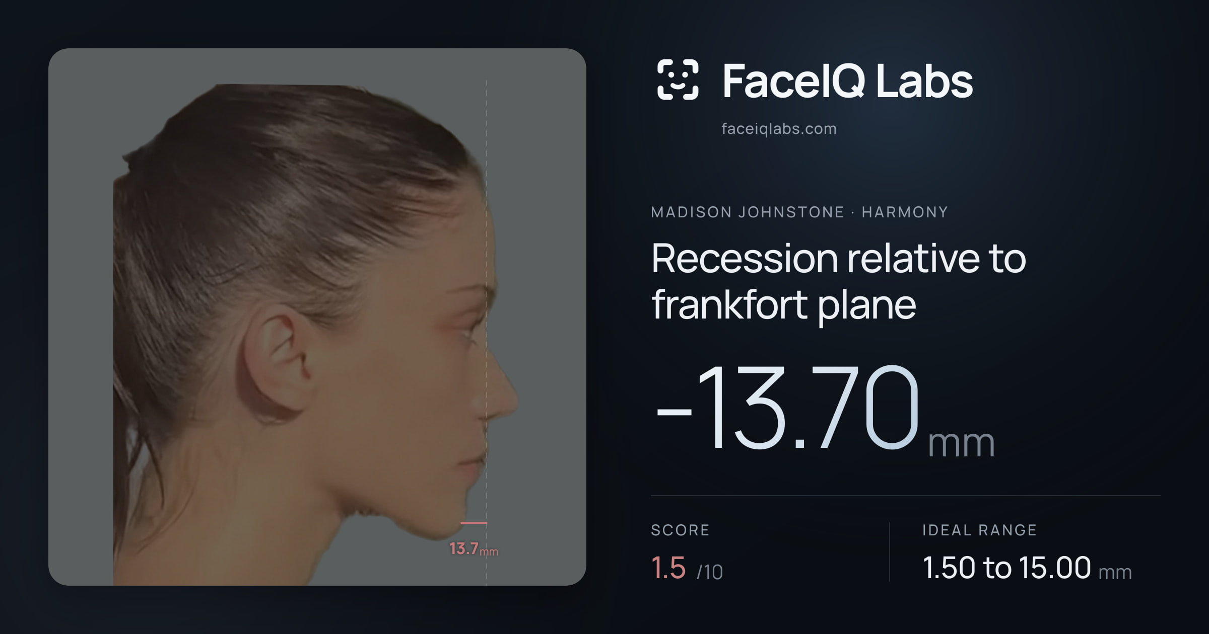 Madison Johnstone Recession relative to frankfort plane: -13.70mm, drawn on the photo