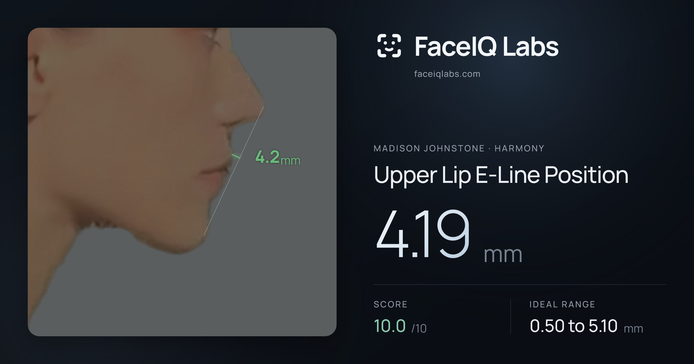 Madison Johnstone Upper Lip E-Line Position: 4.19mm, drawn on the photo