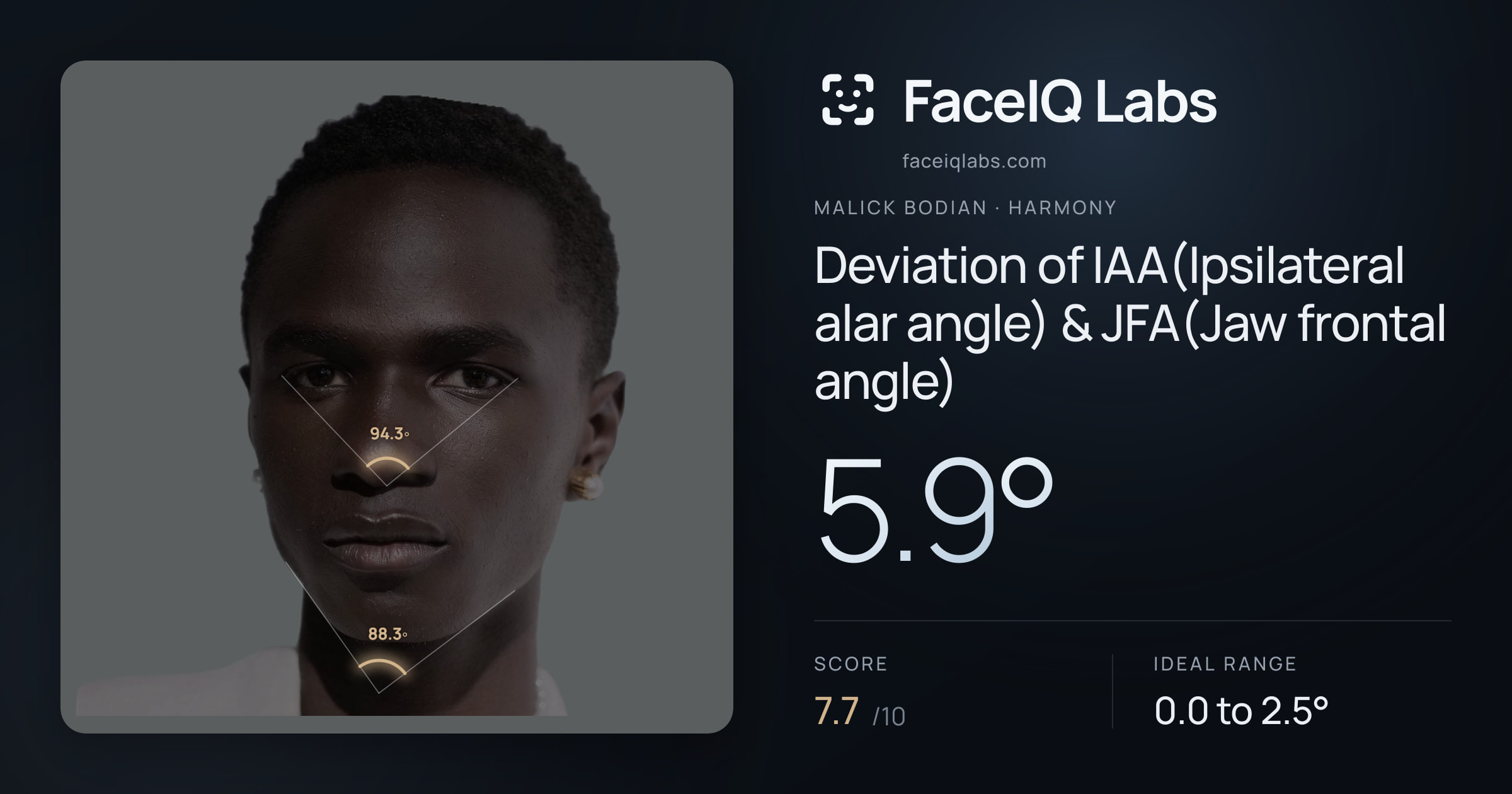 Malick Bodian Deviation of IAA(Ipsilateral alar angle) & JFA(Jaw frontal angle): 5.9°, drawn on the photo