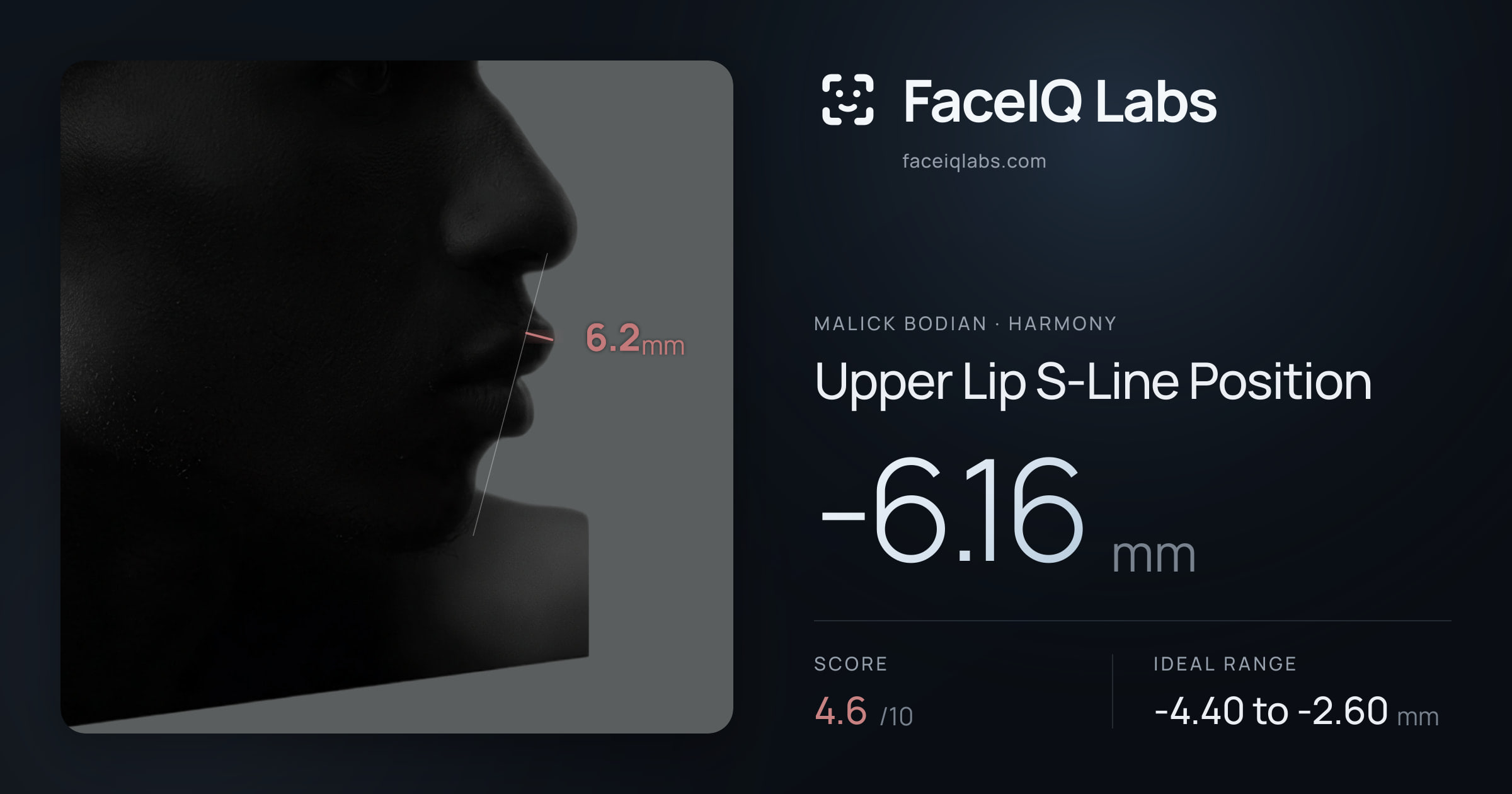 Malick Bodian Upper Lip S-Line Position: -6.16mm, drawn on the photo