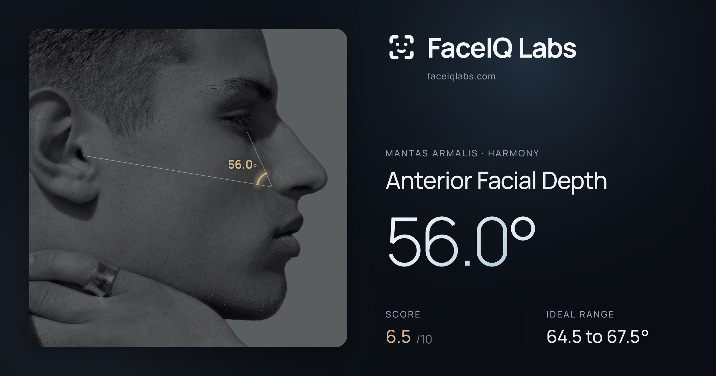 Mantas Armalis Anterior Facial Depth: 56.0°, drawn on the photo