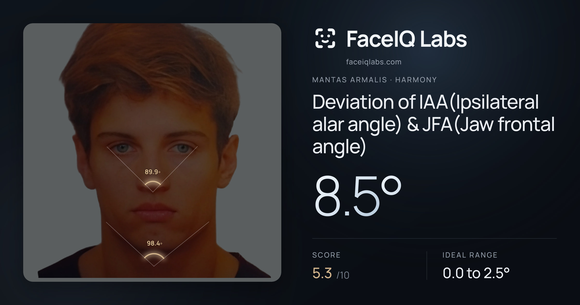 Mantas Armalis Deviation of IAA(Ipsilateral alar angle) & JFA(Jaw frontal angle): 8.5°, drawn on the photo